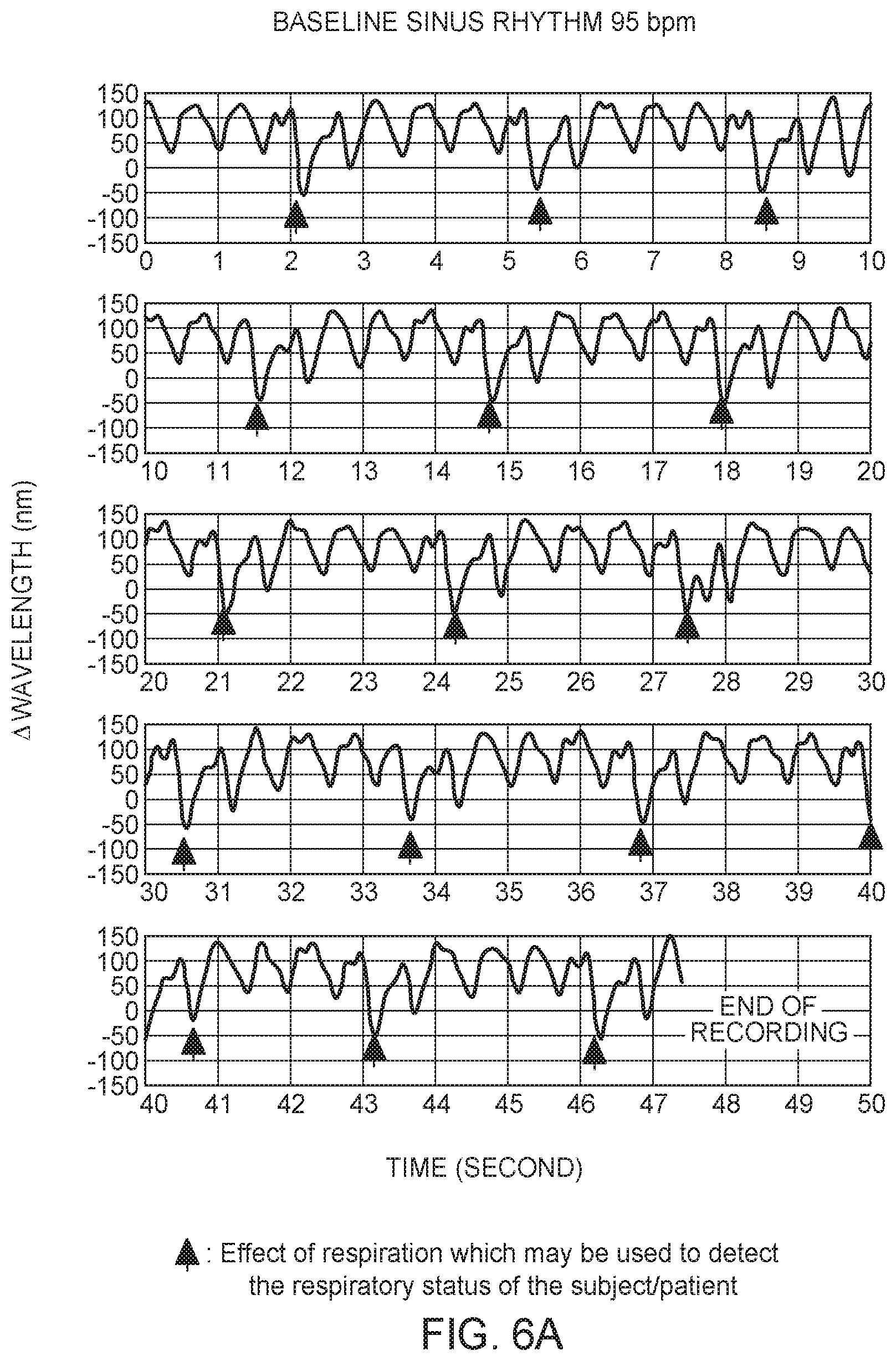 Patent US12350021 Figure 5 – Non-barometric determination of hemodynamic effects of cardiac arrhythmias using signals sensed by an implantable device