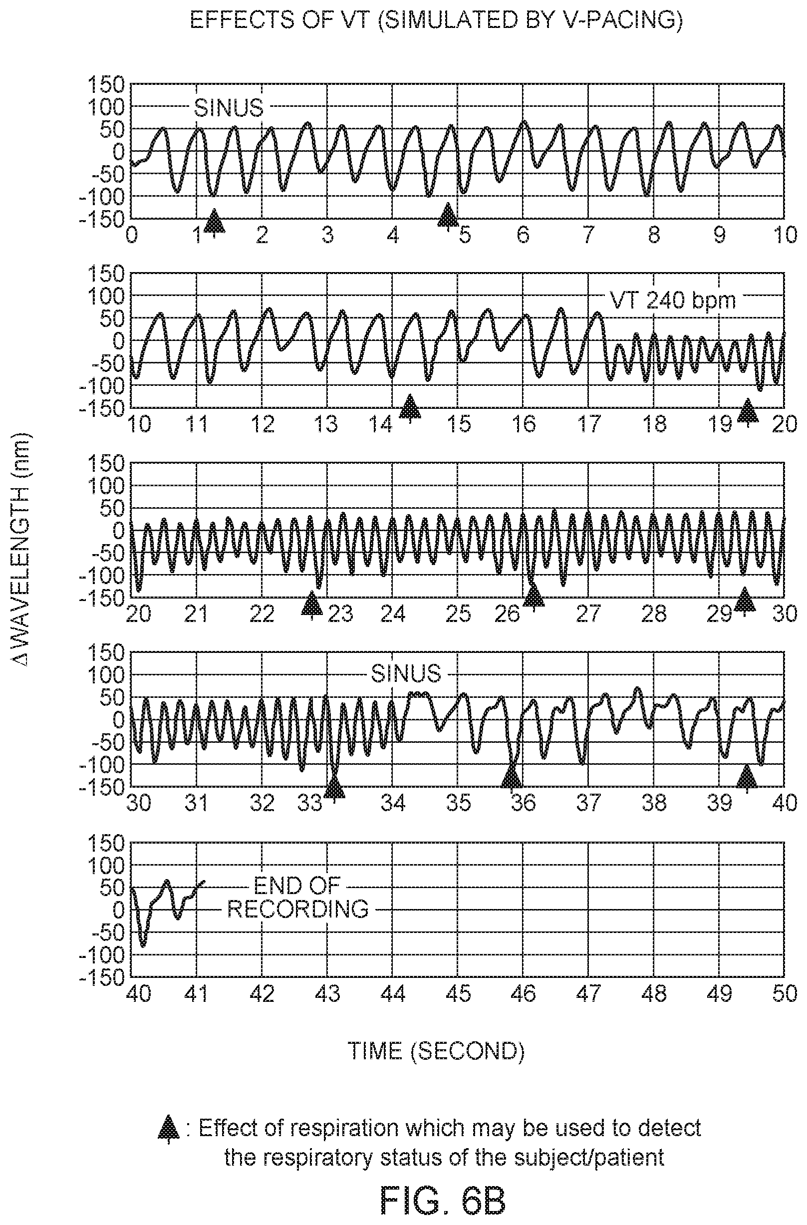 Patent US12350021 Figure 6 – Non-barometric determination of hemodynamic effects of cardiac arrhythmias using signals sensed by an implantable device