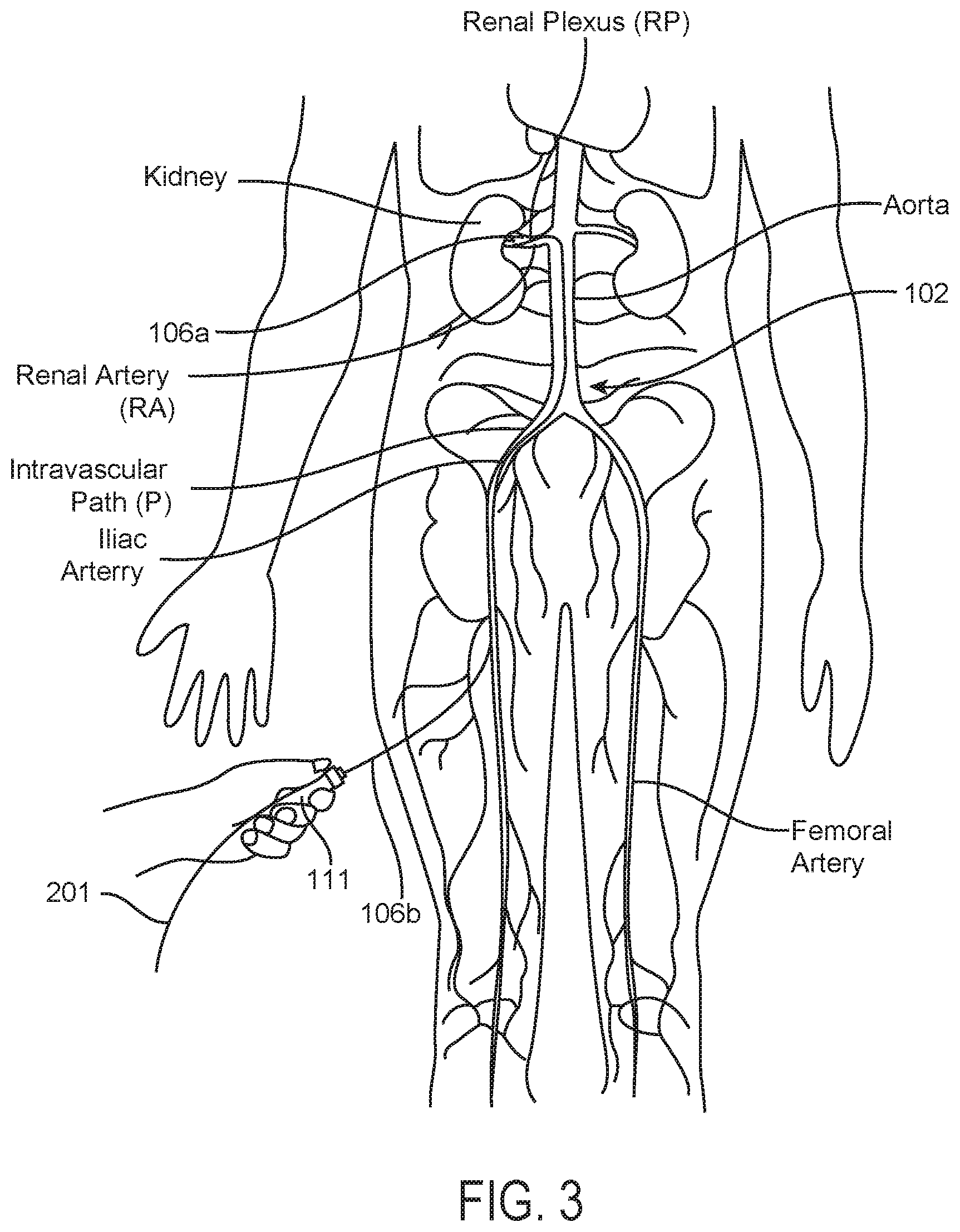 Patent US12350028 Figure 4 – Systems and methods for assessing efficacy of renal neuromodulation therapy