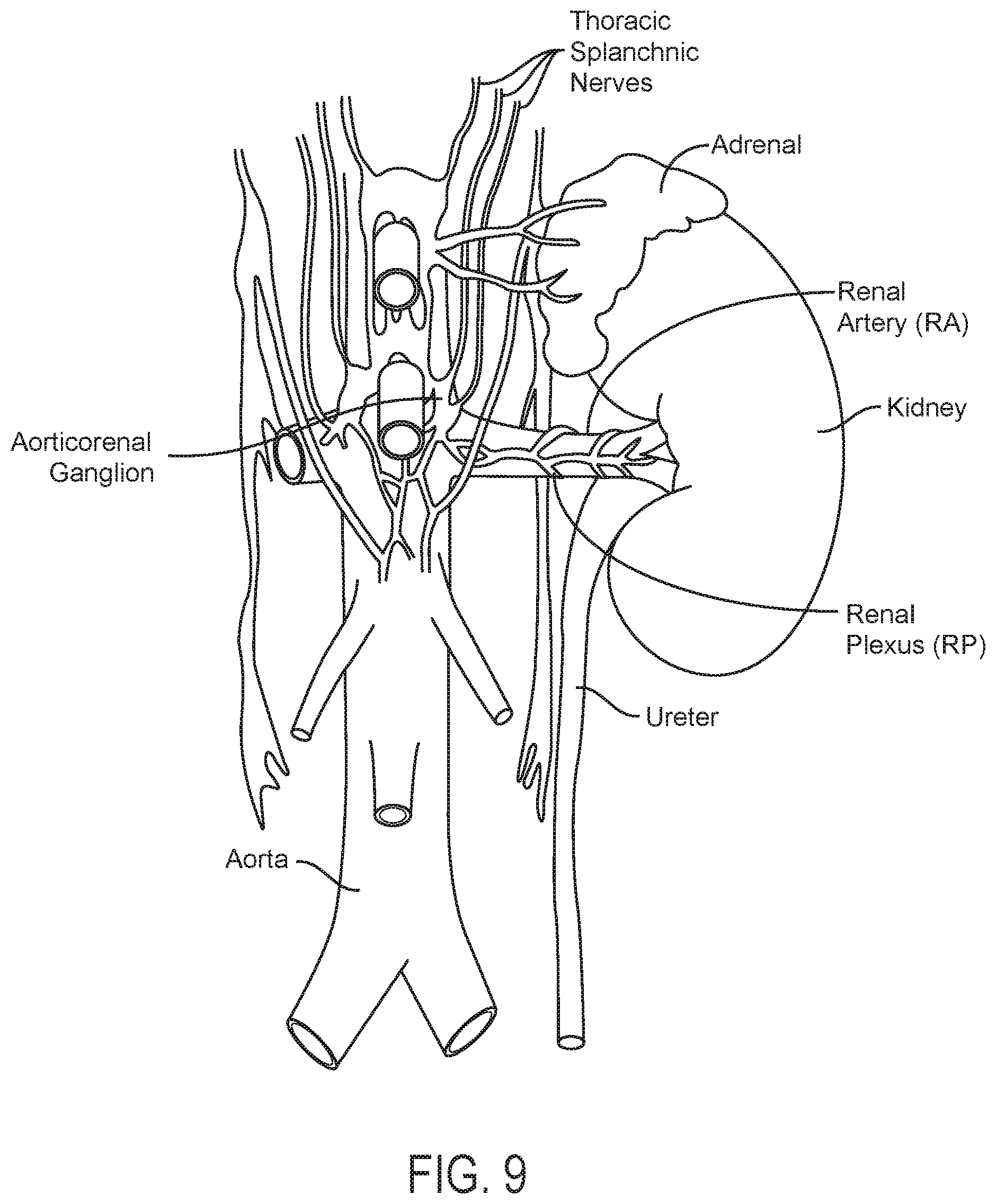 Patent US12350028 Figure 9 – Systems and methods for assessing efficacy of renal neuromodulation therapy