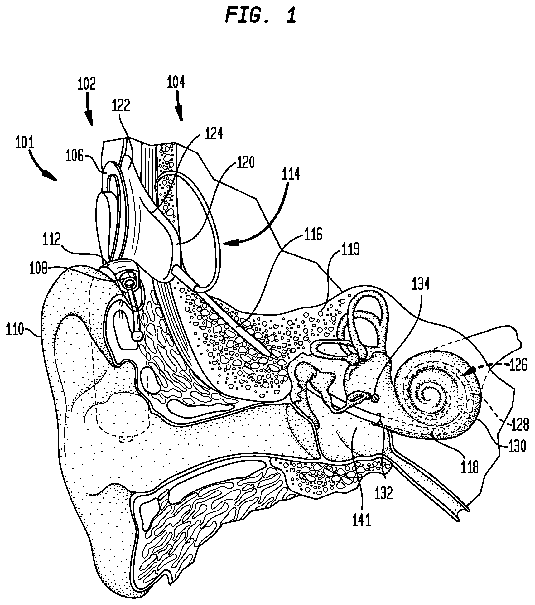 Patent US12350030 Figure 1 – Event detection in an implantable auditory prosthesis