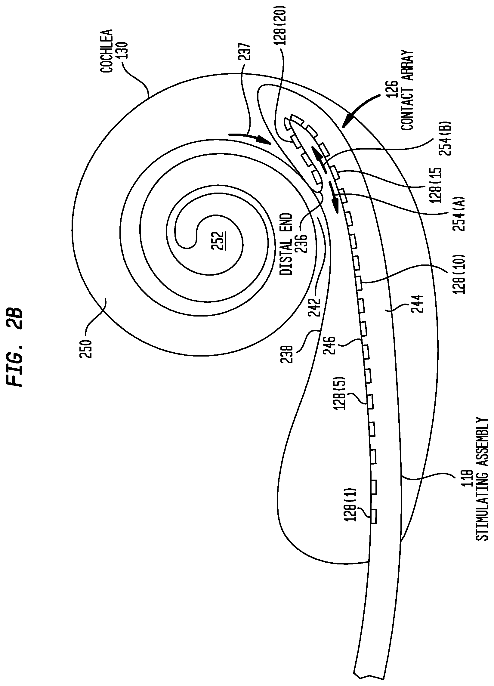 Patent US12350030 Figure 3 – Event detection in an implantable auditory prosthesis