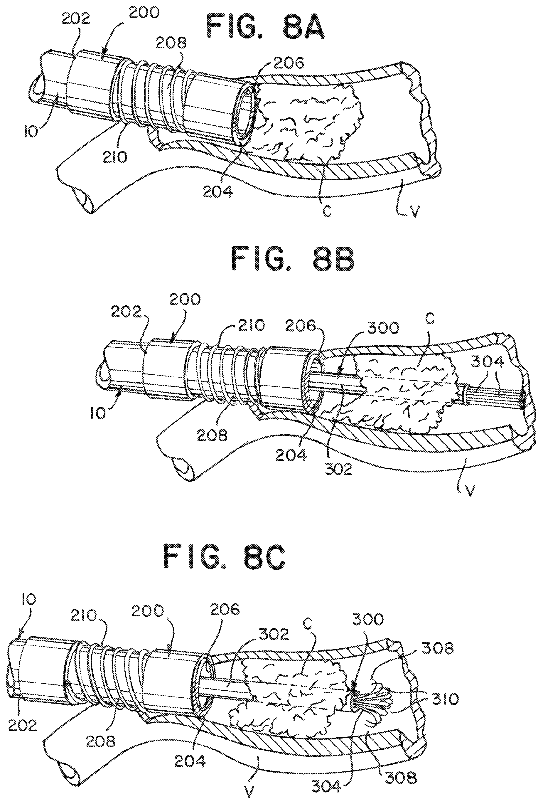Patent US12350033 Figure 4 – Device and method to detect and remove blood clots for treatment of ischemic stroke using force and electromagnetic sensing