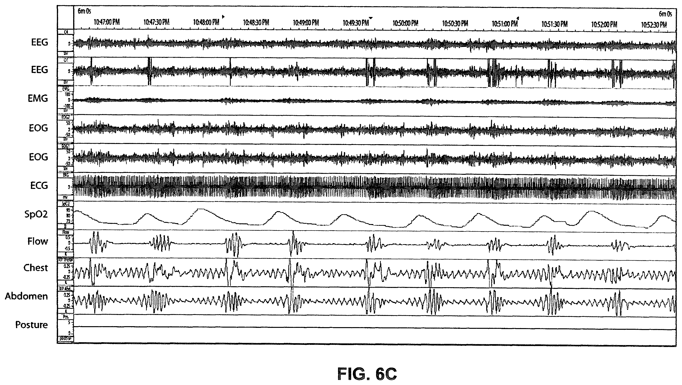 Patent US12350034 Figure 9 – Methods and apparatus for detection of disordered breathing