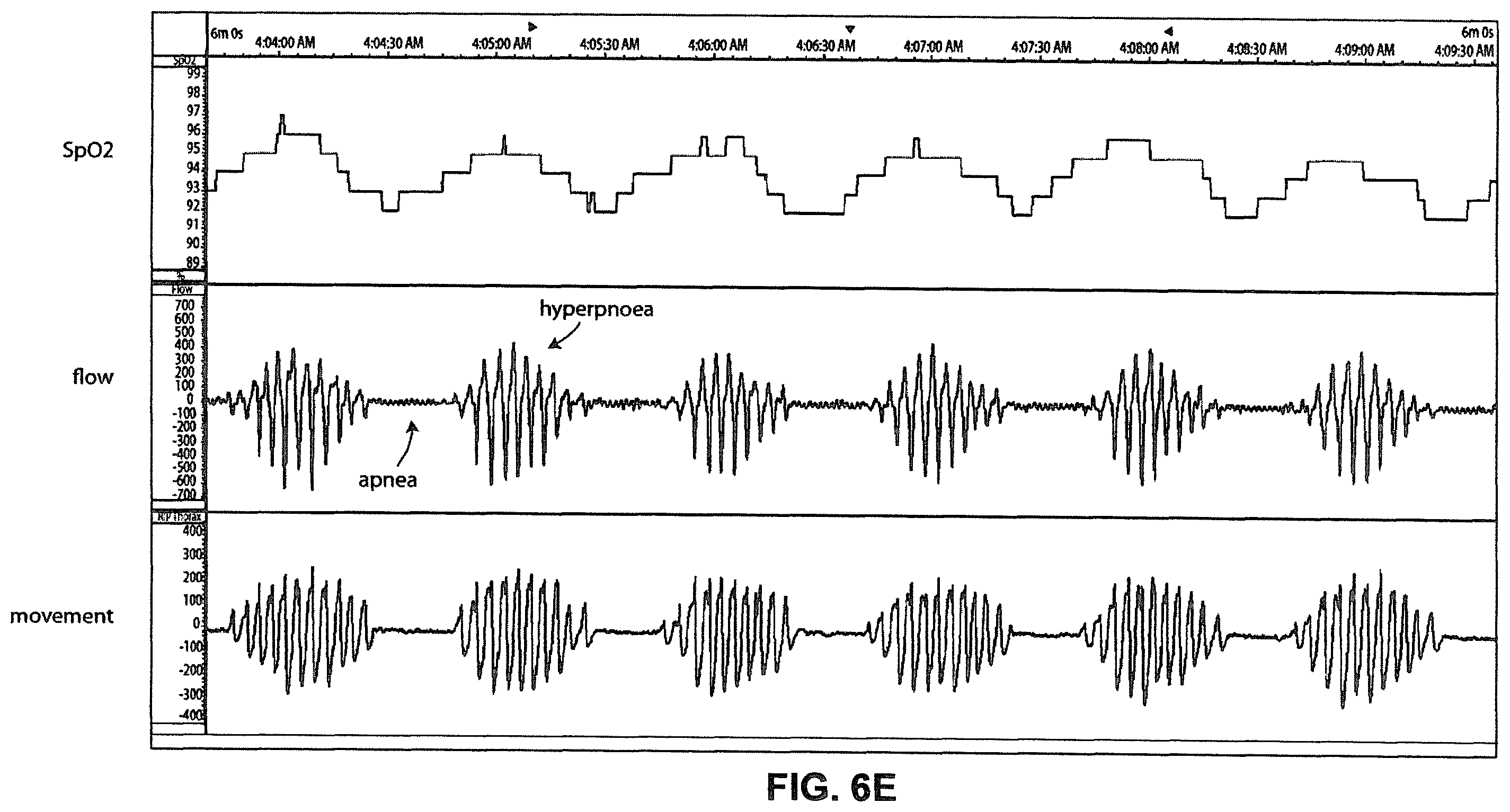 Patent US12350034 Figure 11 – Methods and apparatus for detection of disordered breathing