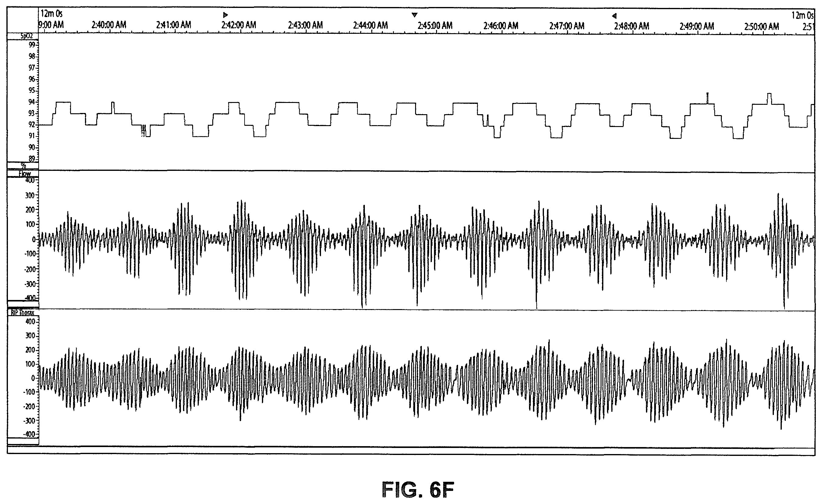 Patent US12350034 Figure 12 – Methods and apparatus for detection of disordered breathing