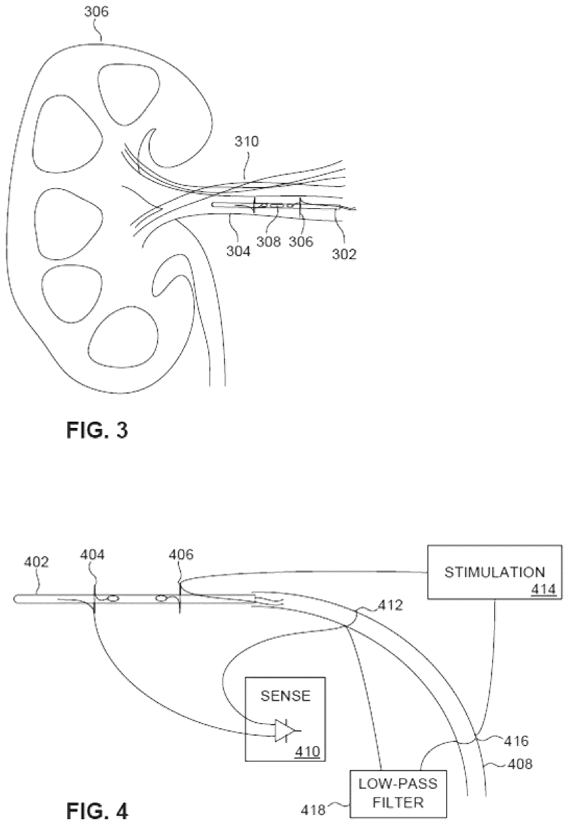 Patent US12350050 Figure 3 – Intraluminal microneurography probes and related systems and methods