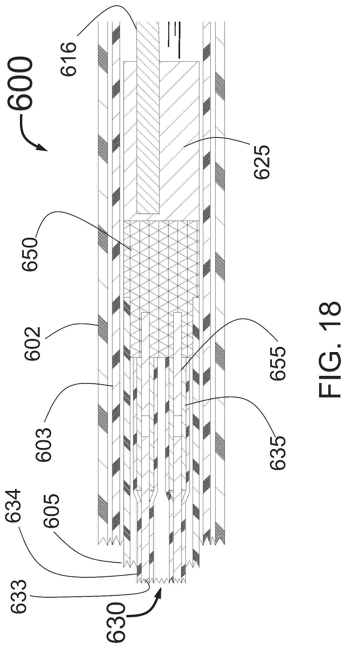 Patent US12350051 Figure 16 – Apparatus for effective ablation and nerve sensing associated with denervation