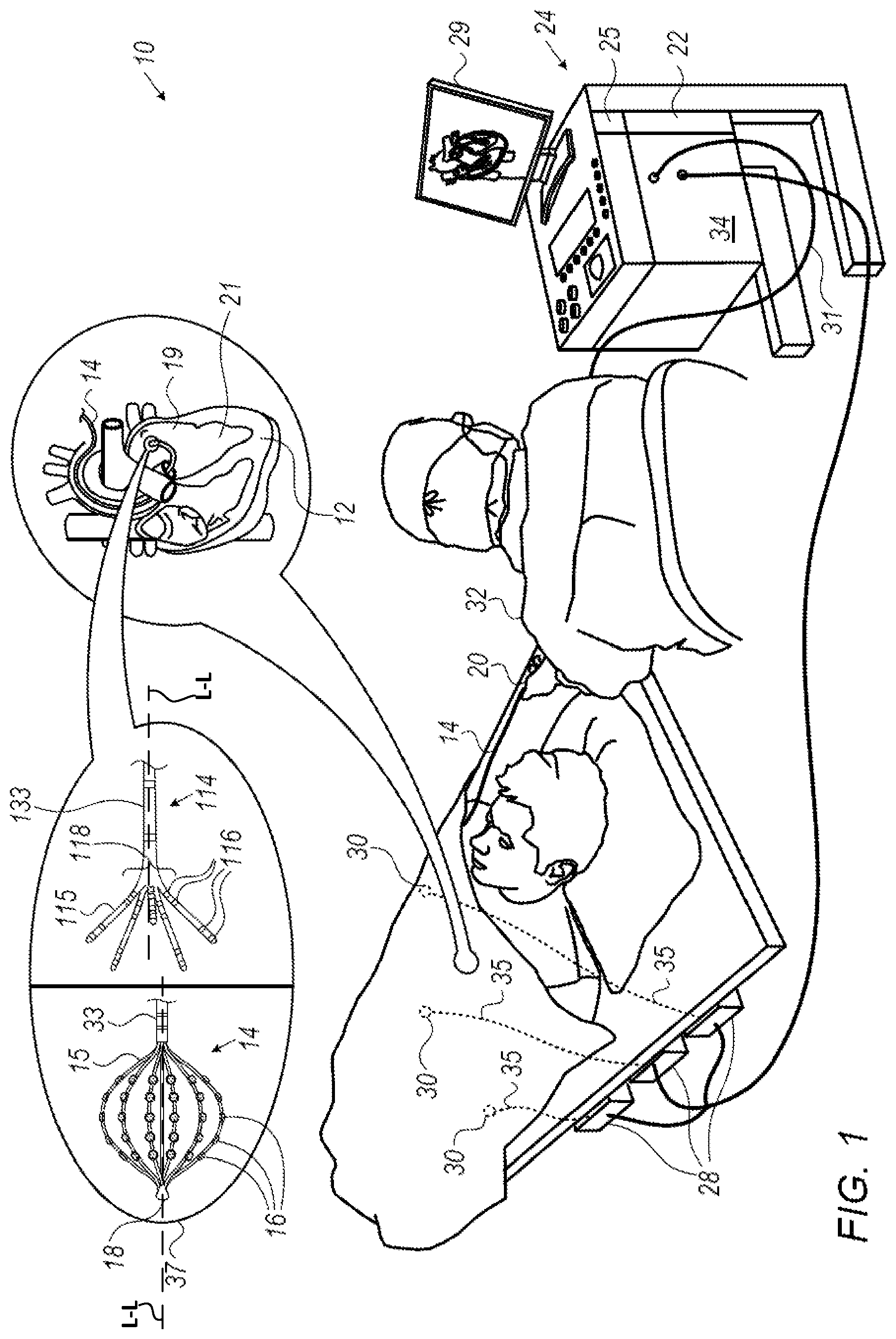Patent US12350057 Figure 1 – Analyzing multi-electrode catheter signals to determine electrophysiological (EP) wave propagation vector