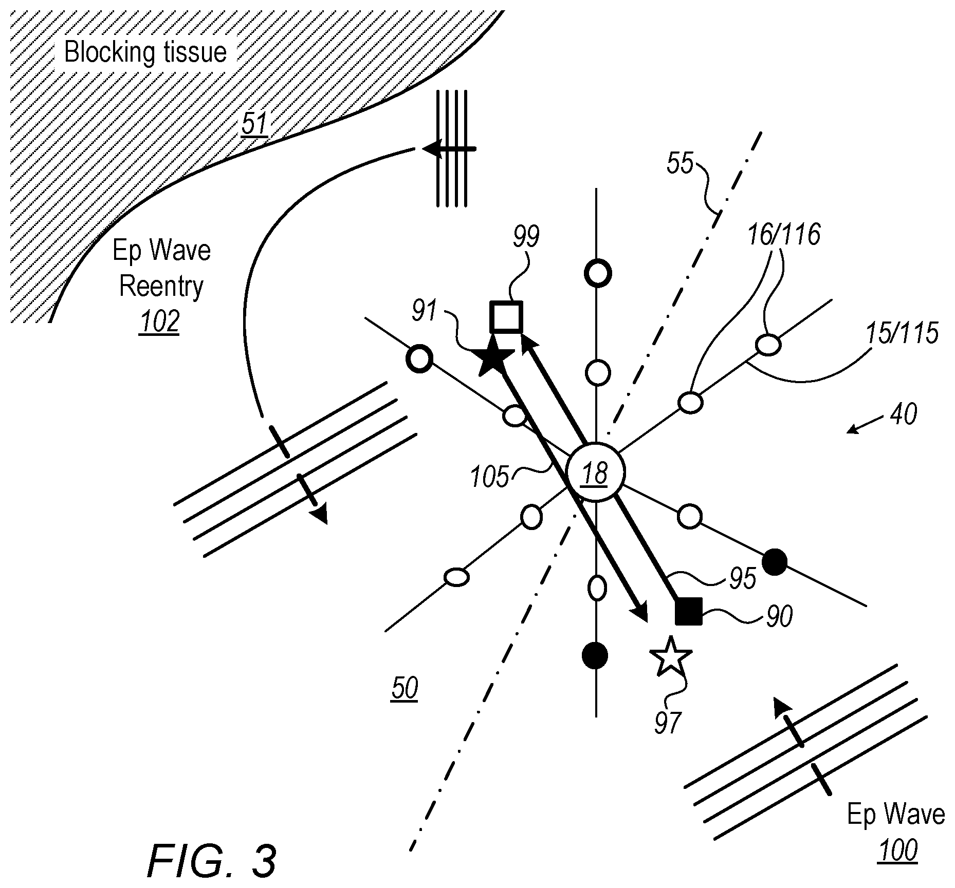 Patent US12350057 Figure 3 – Analyzing multi-electrode catheter signals to determine electrophysiological (EP) wave propagation vector