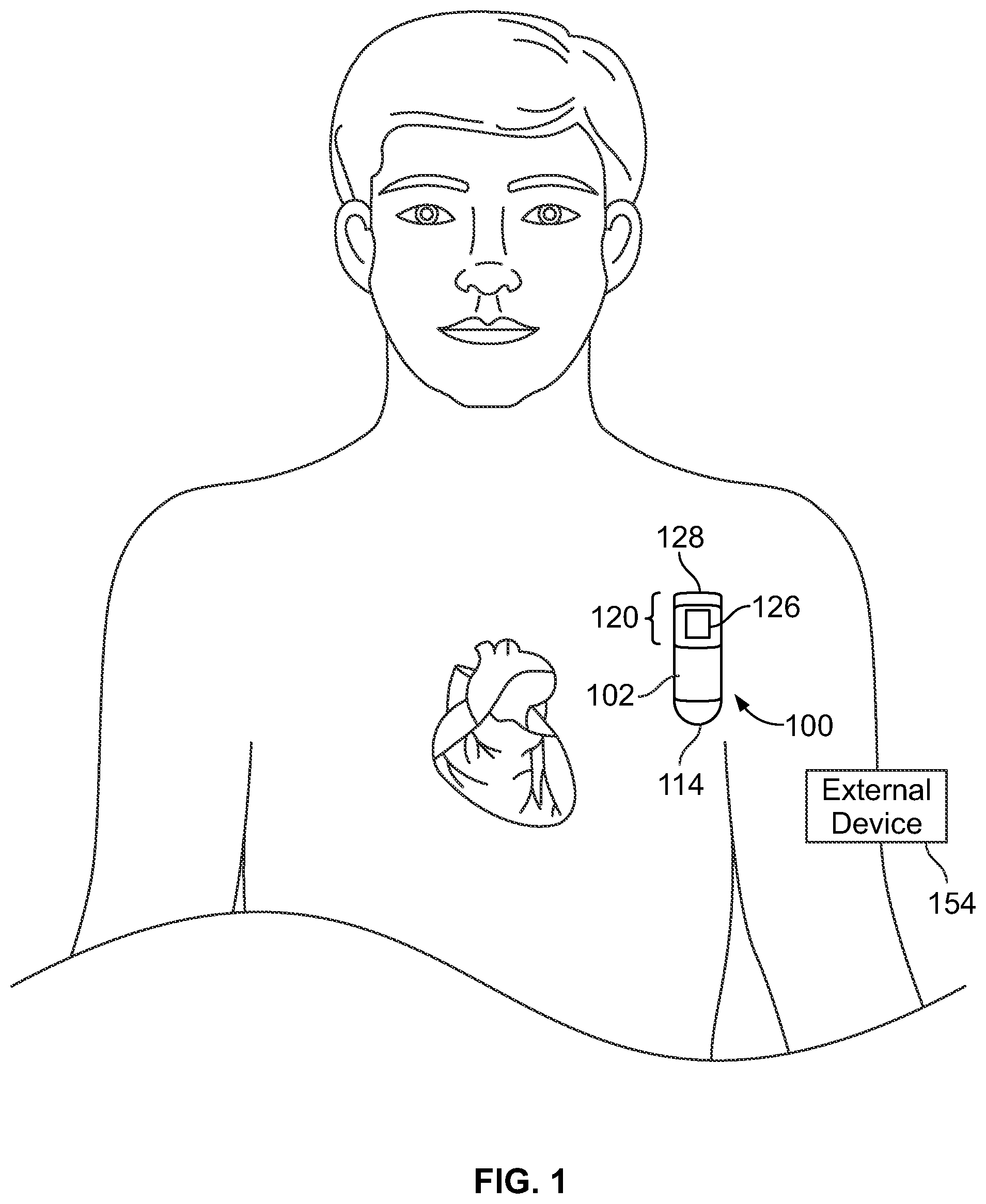 Patent US12350058 Figure 1 – System for identifying premature ventricular contractions