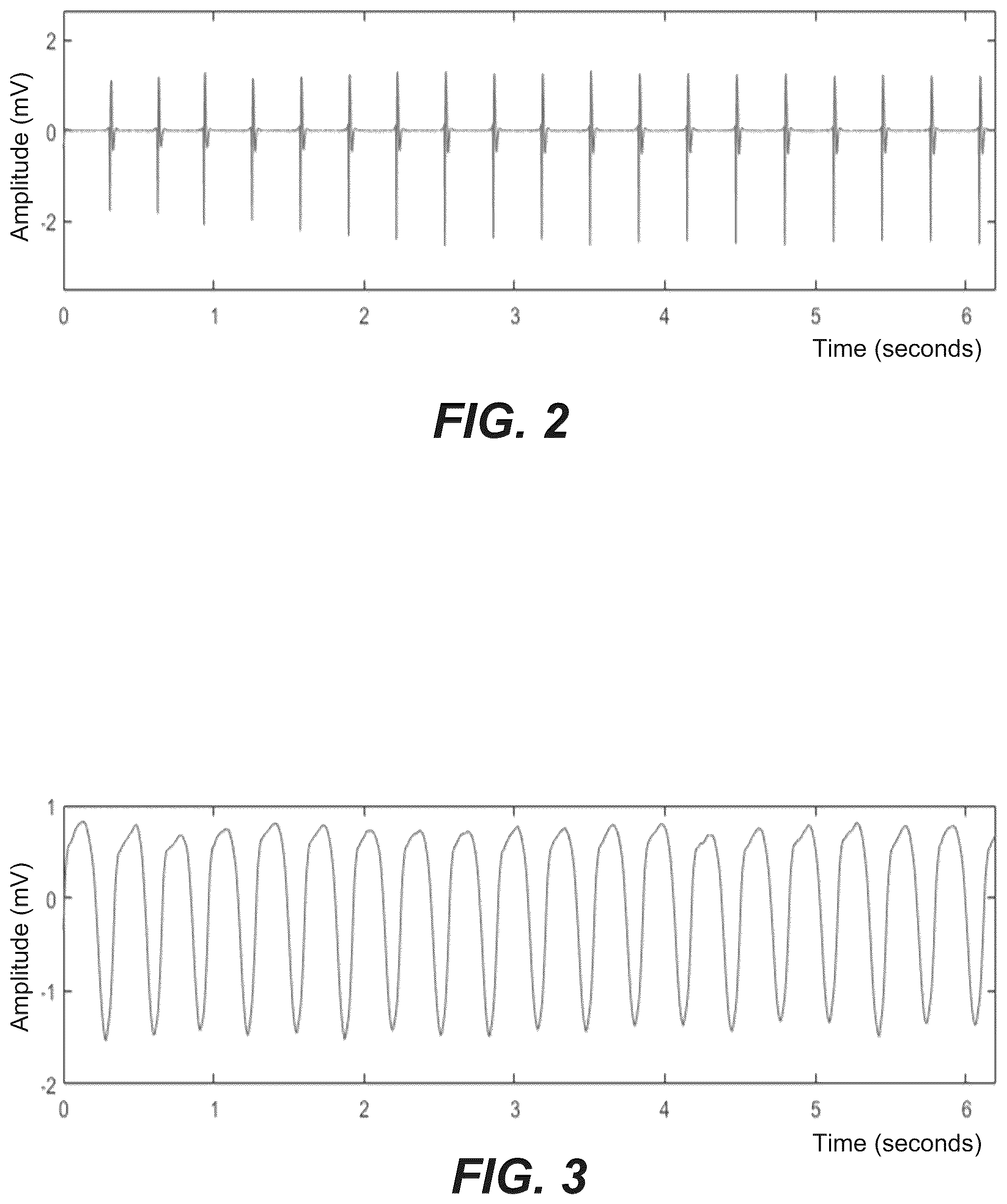 Patent US12350059 Figure 2 – Robust ventricular sensing of far-field EGM or ECG signals that avoids oversensing of ventricular sensed events