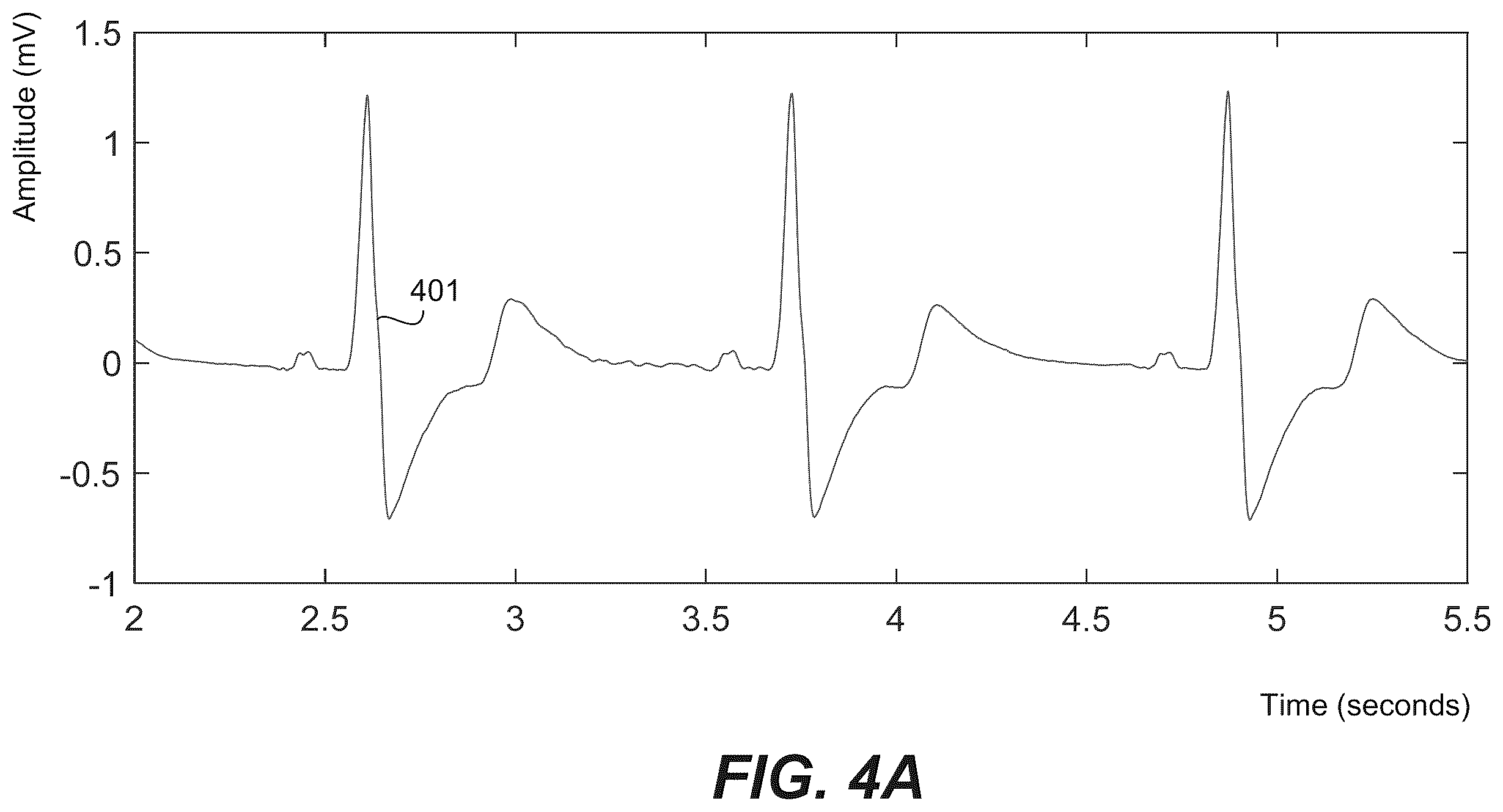 Patent US12350059 Figure 3 – Robust ventricular sensing of far-field EGM or ECG signals that avoids oversensing of ventricular sensed events