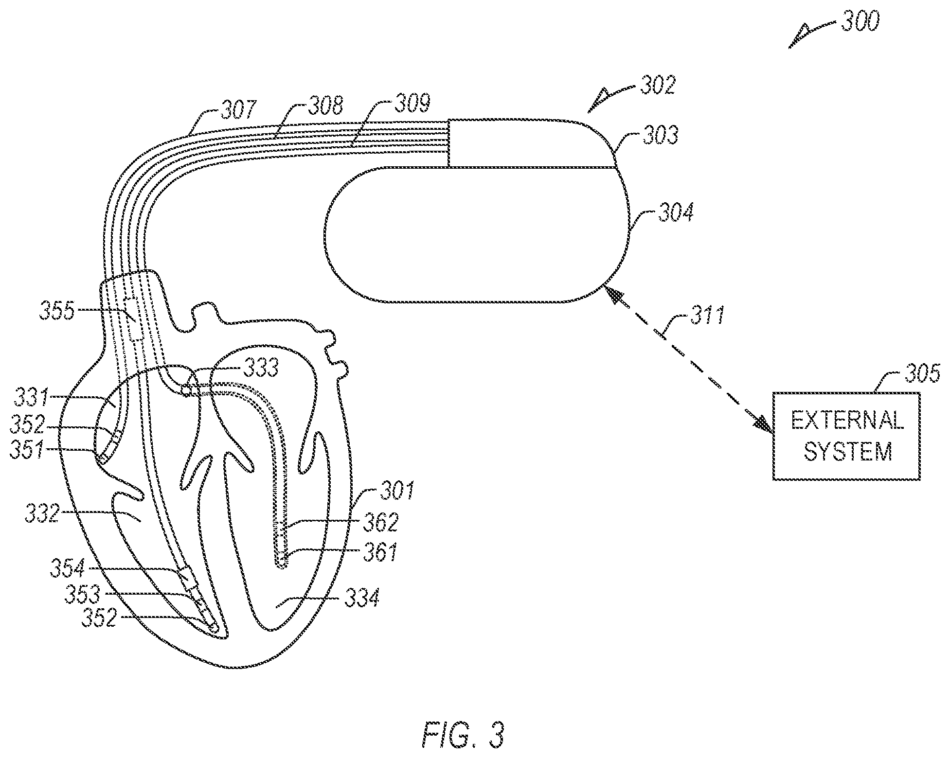 Patent US12350060 Figure 2 – PVC adjusted AF detection