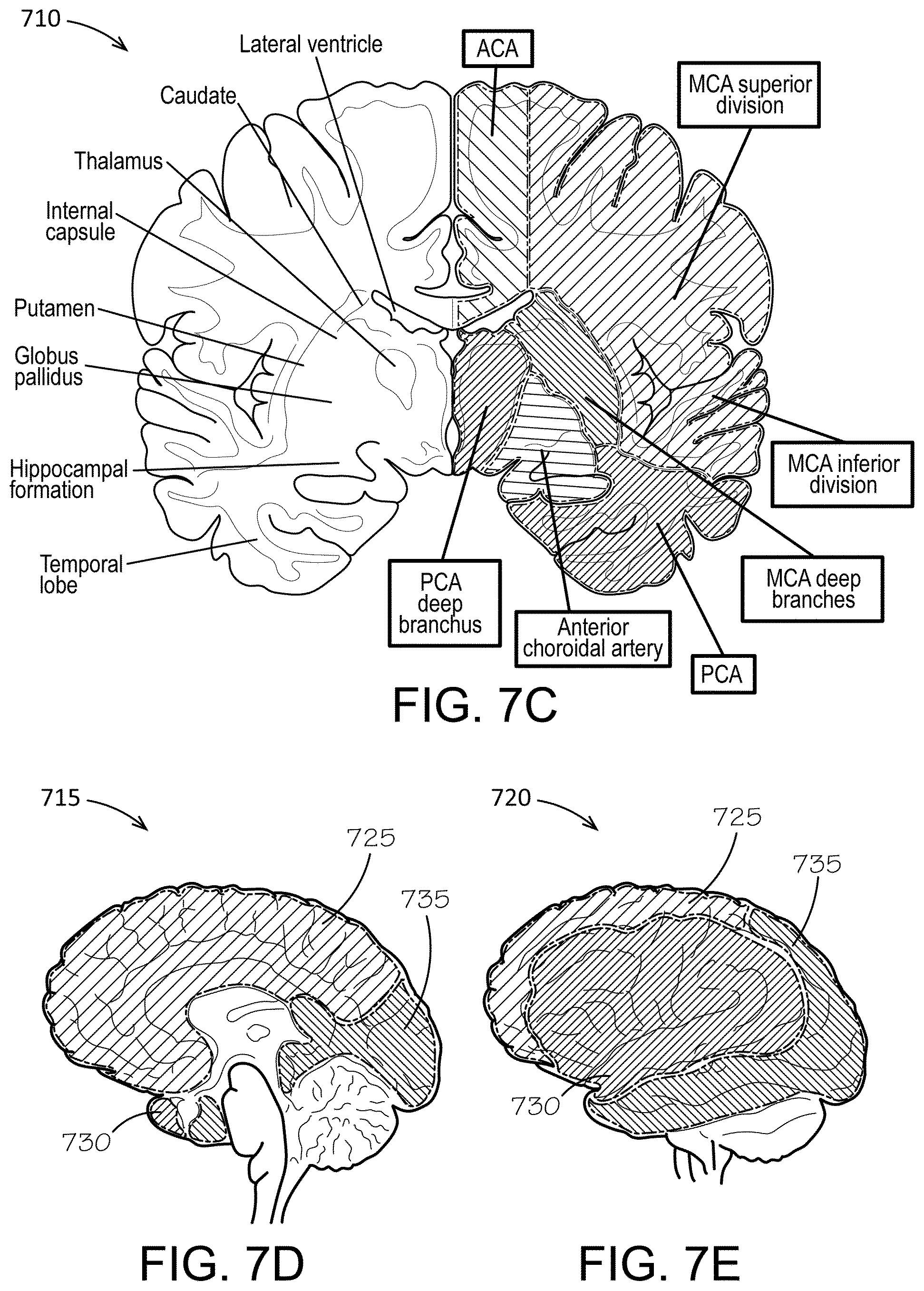 Patent US12350074 Figure 10 – Stroke prediction multi-architecture stacked ensemble supermodel