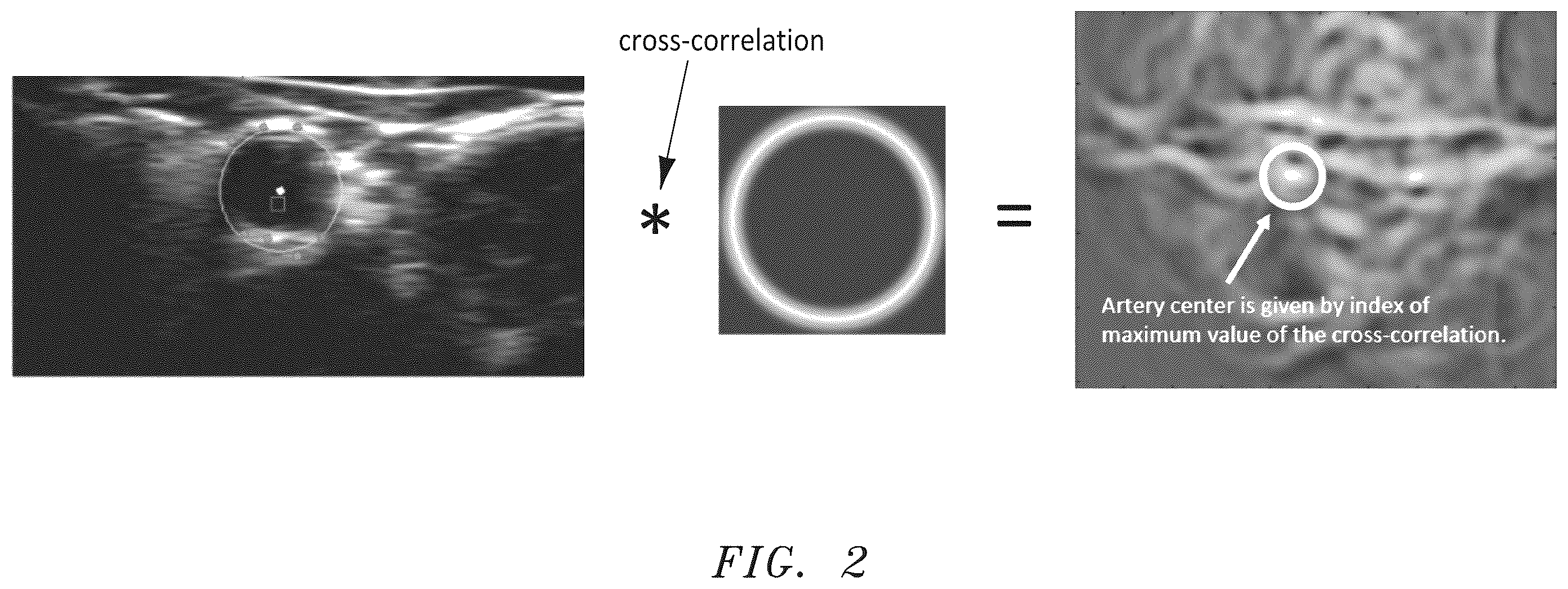 Patent US12350093 Figure 2 – Apparatus and method for tracking blood vessel cross-section