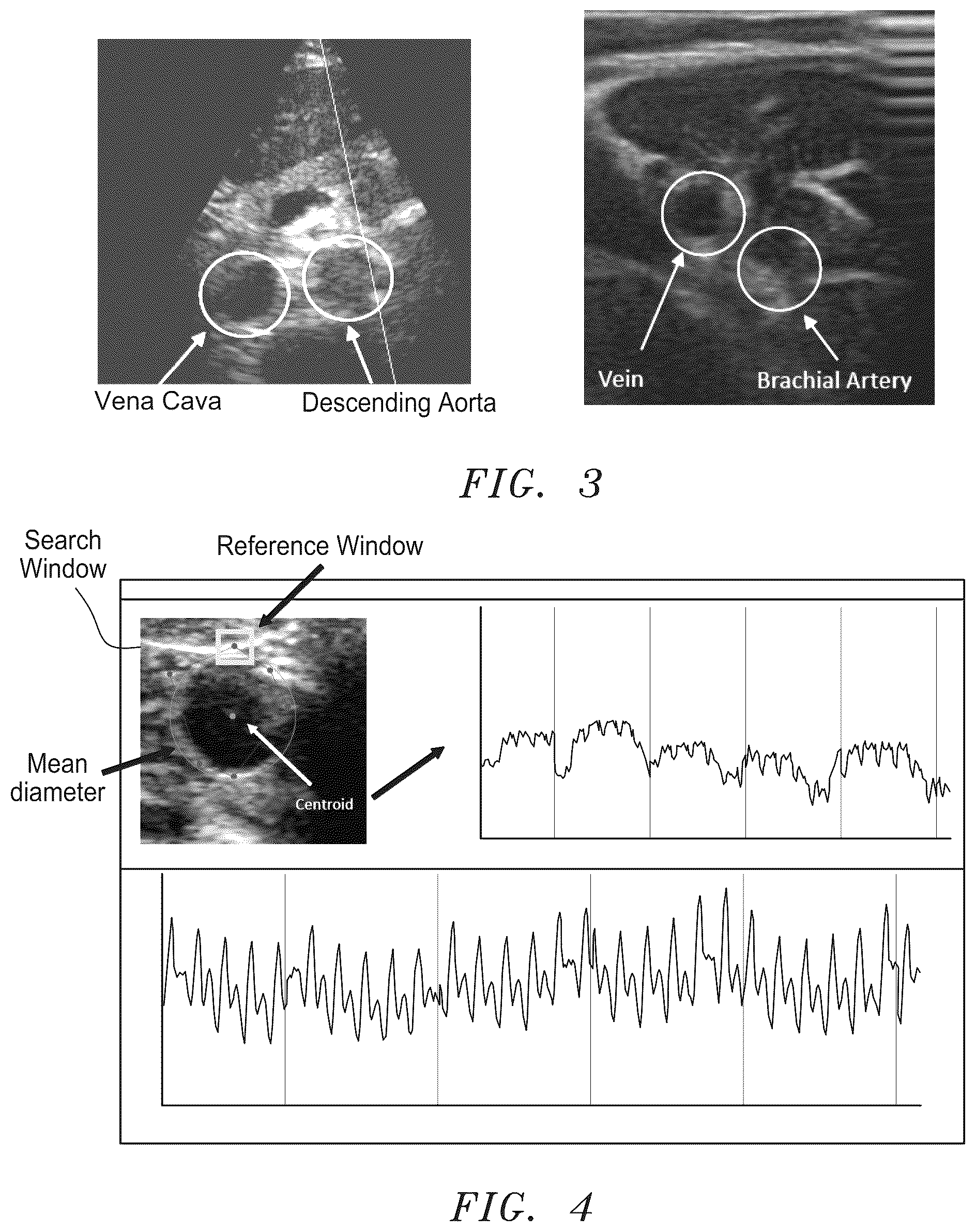Patent US12350093 Figure 3 – Apparatus and method for tracking blood vessel cross-section