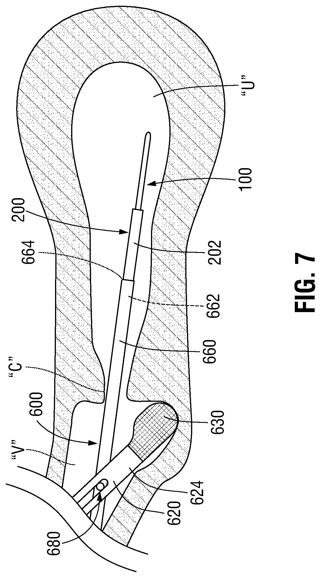 Patent US12350097 Figure 5 – Devices, systems, and methods for trans-vaginal, ultrasound-guided hysteroscopic surgical procedures