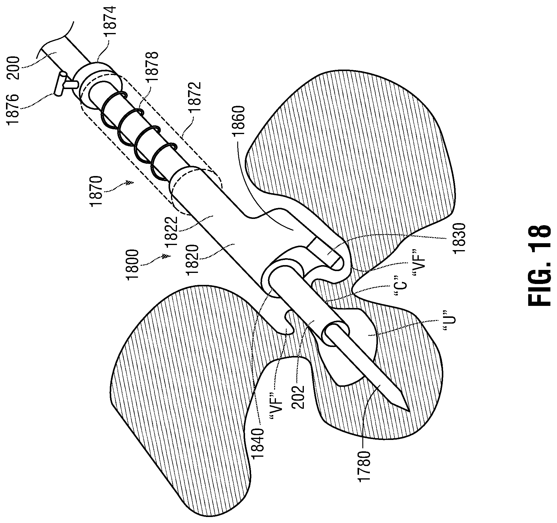 Patent US12350097 Figure 17 – Devices, systems, and methods for trans-vaginal, ultrasound-guided hysteroscopic surgical procedures