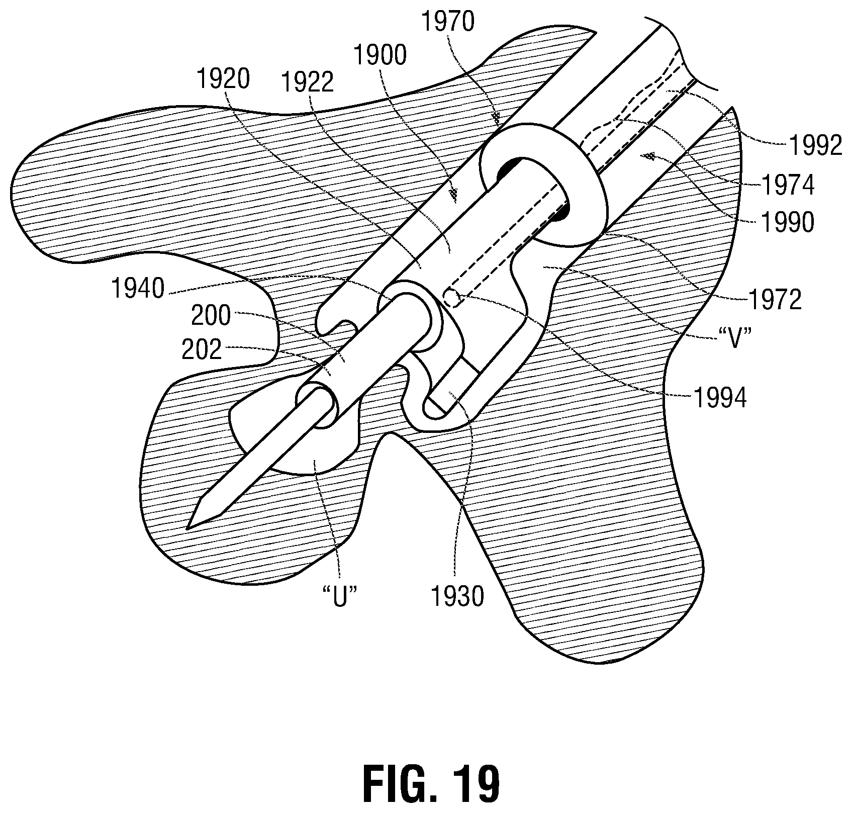 Patent US12350097 Figure 18 – Devices, systems, and methods for trans-vaginal, ultrasound-guided hysteroscopic surgical procedures