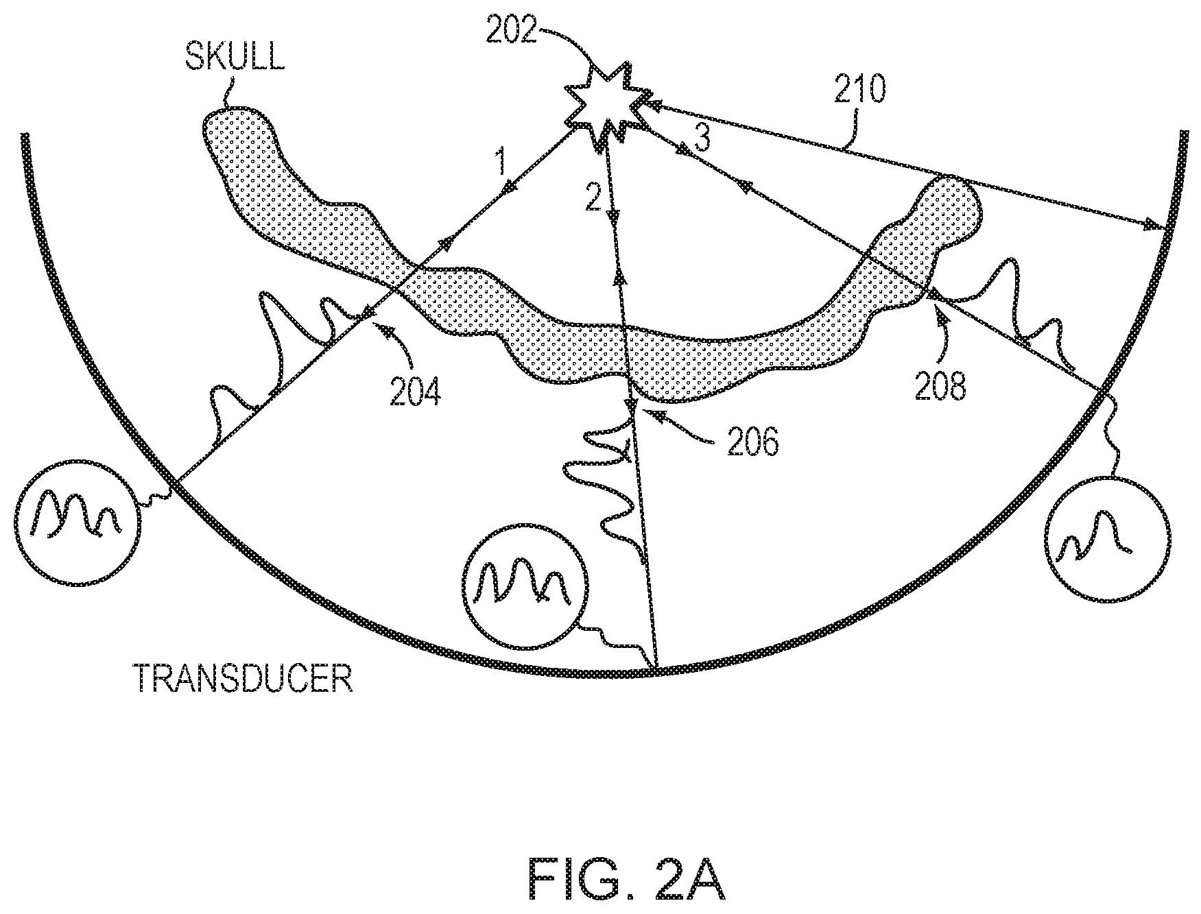 Patent US12350107 Figure 2 – Systems and methods for providing tissue information in an anatomic target region using acoustic reflectors