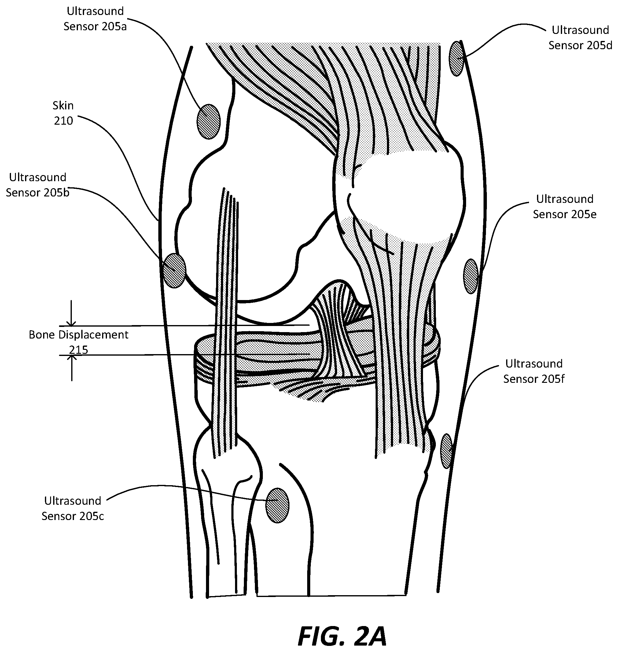 Patent US12350108 Figure 2 – Wearable imaging system for measuring bone displacement