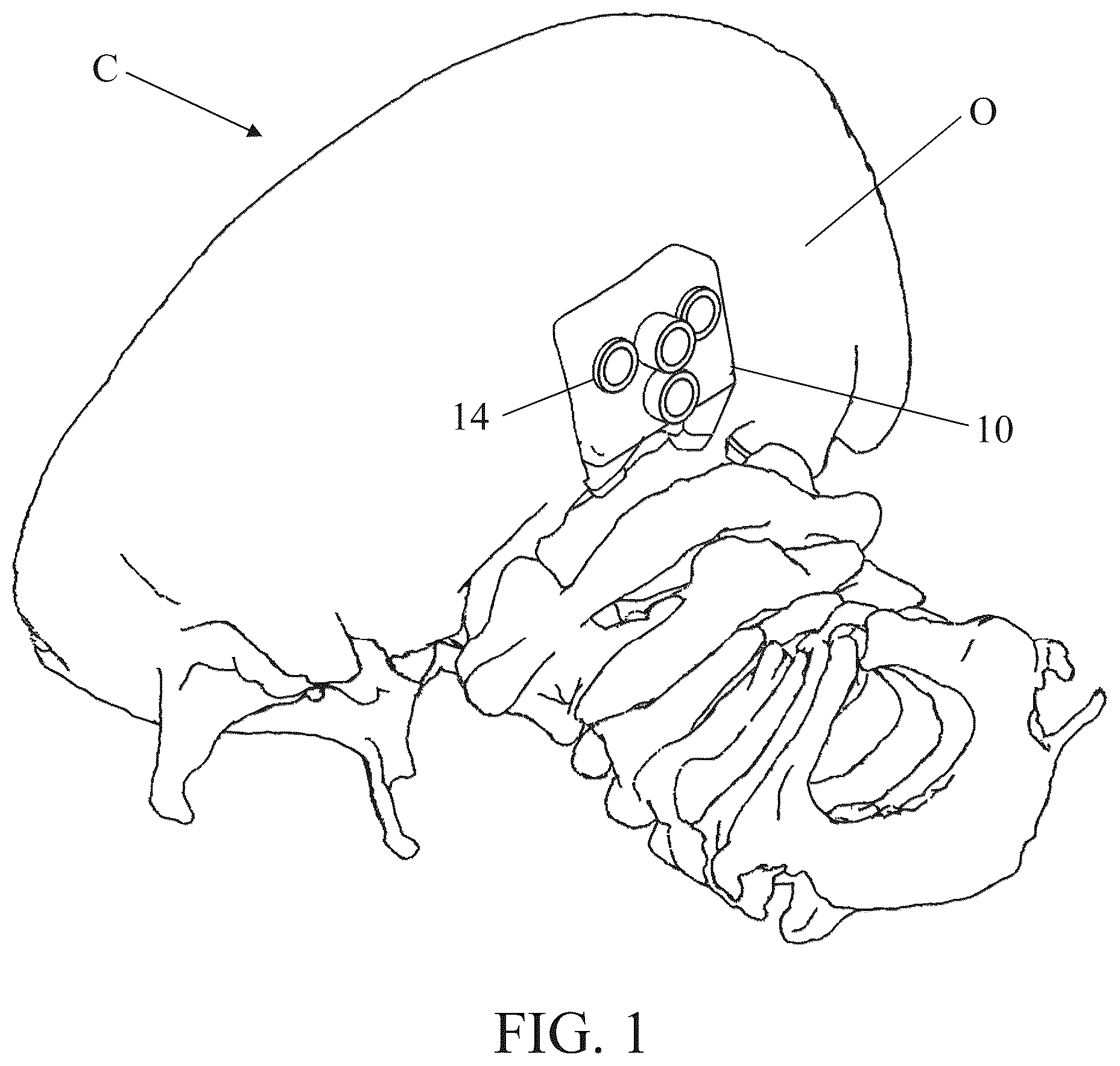 Patent US12350111 Figure 1 – Patient-matched apparatus for use in robotic assisted surgical procedures and methods for using the same