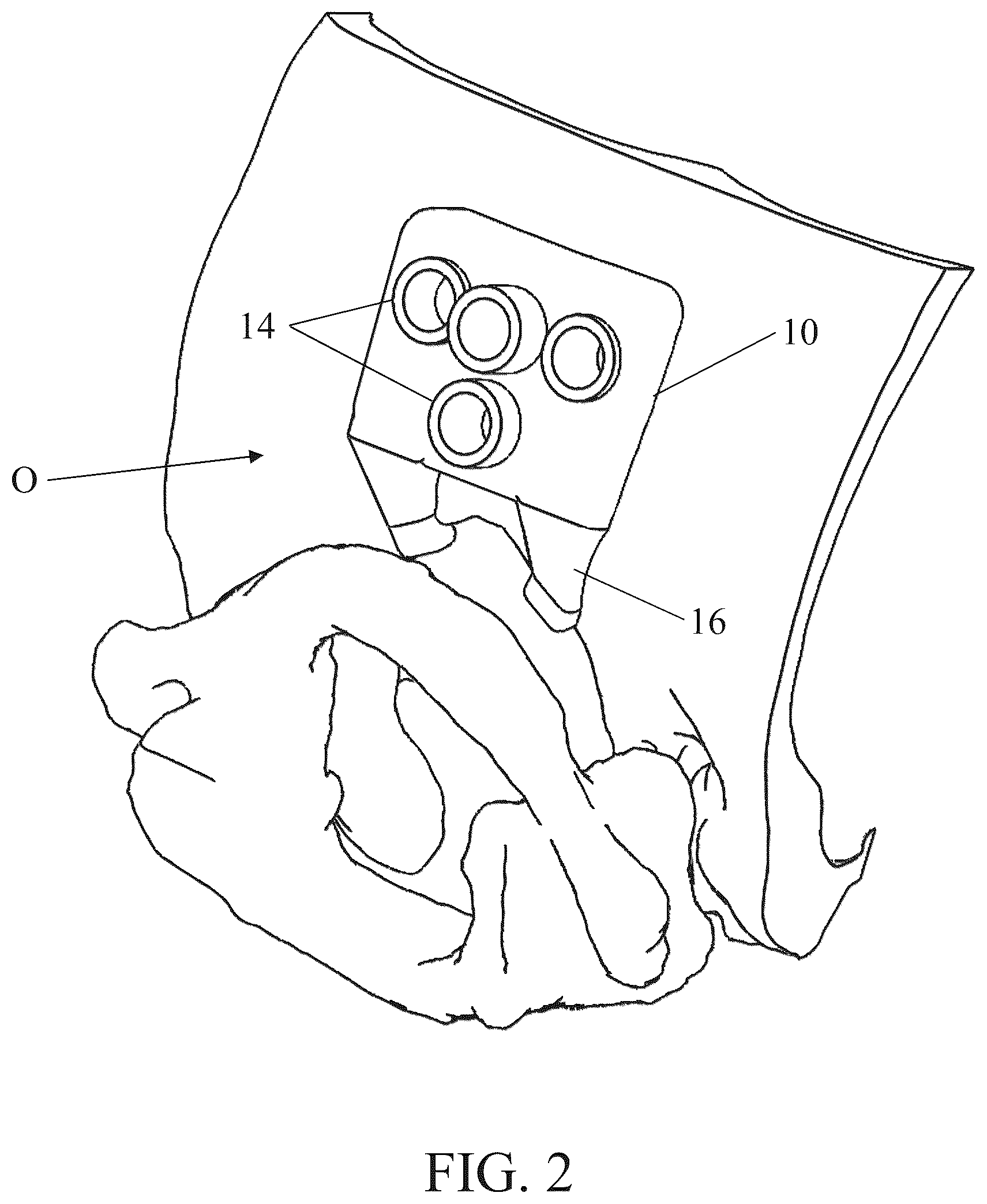 Patent US12350111 Figure 2 – Patient-matched apparatus for use in robotic assisted surgical procedures and methods for using the same