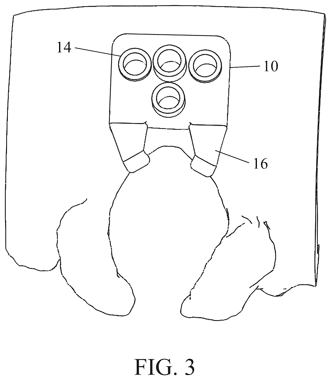 Patent US12350111 Figure 3 – Patient-matched apparatus for use in robotic assisted surgical procedures and methods for using the same