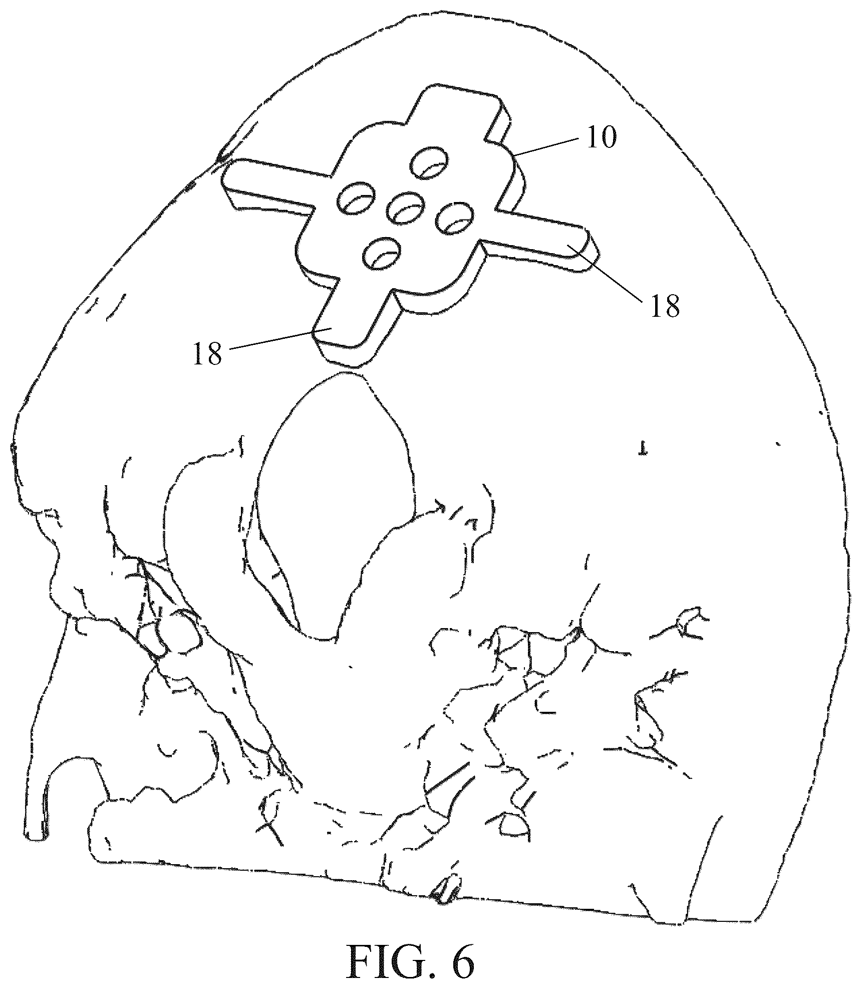 Patent US12350111 Figure 6 – Patient-matched apparatus for use in robotic assisted surgical procedures and methods for using the same