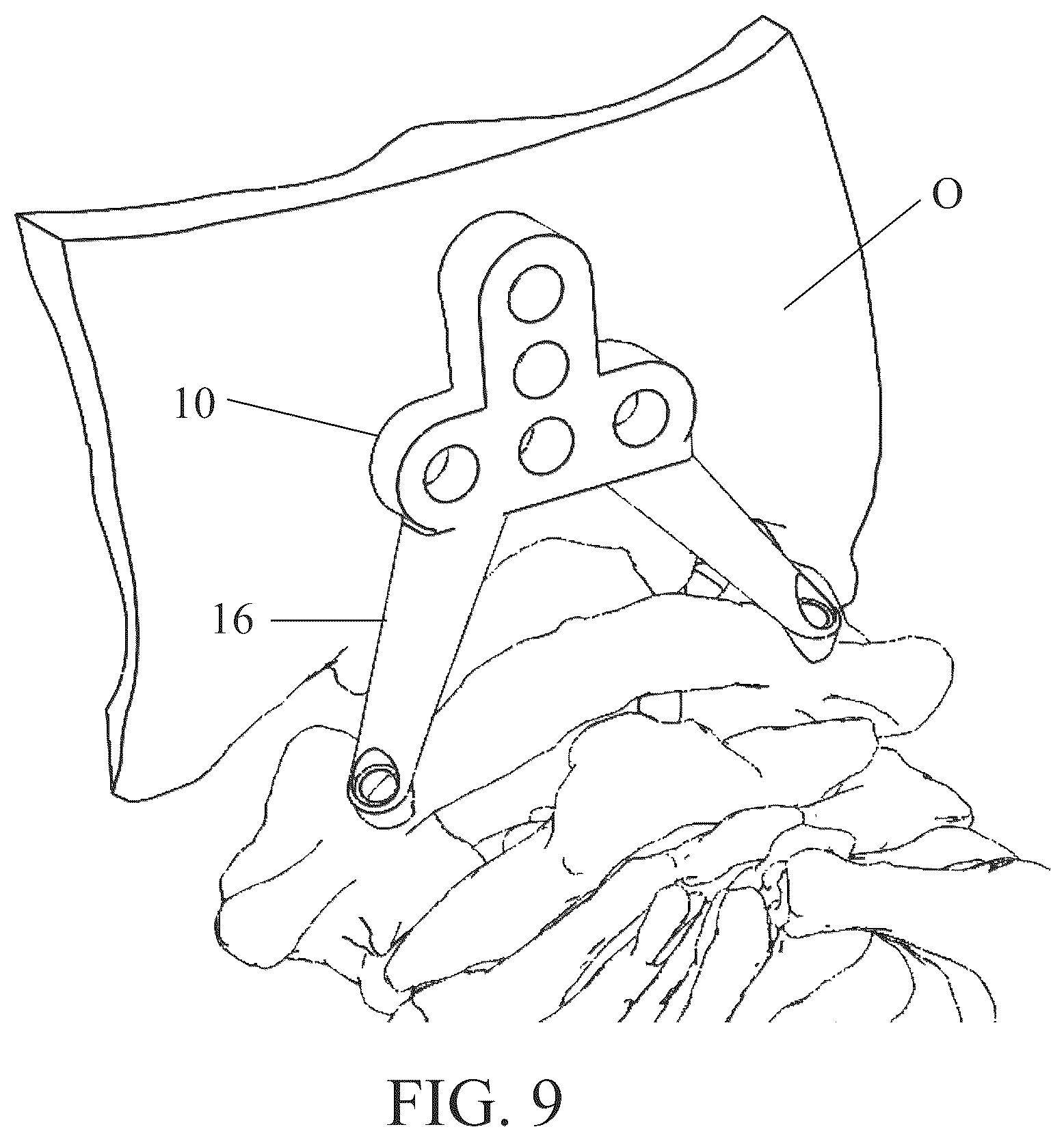 Patent US12350111 Figure 9 – Patient-matched apparatus for use in robotic assisted surgical procedures and methods for using the same