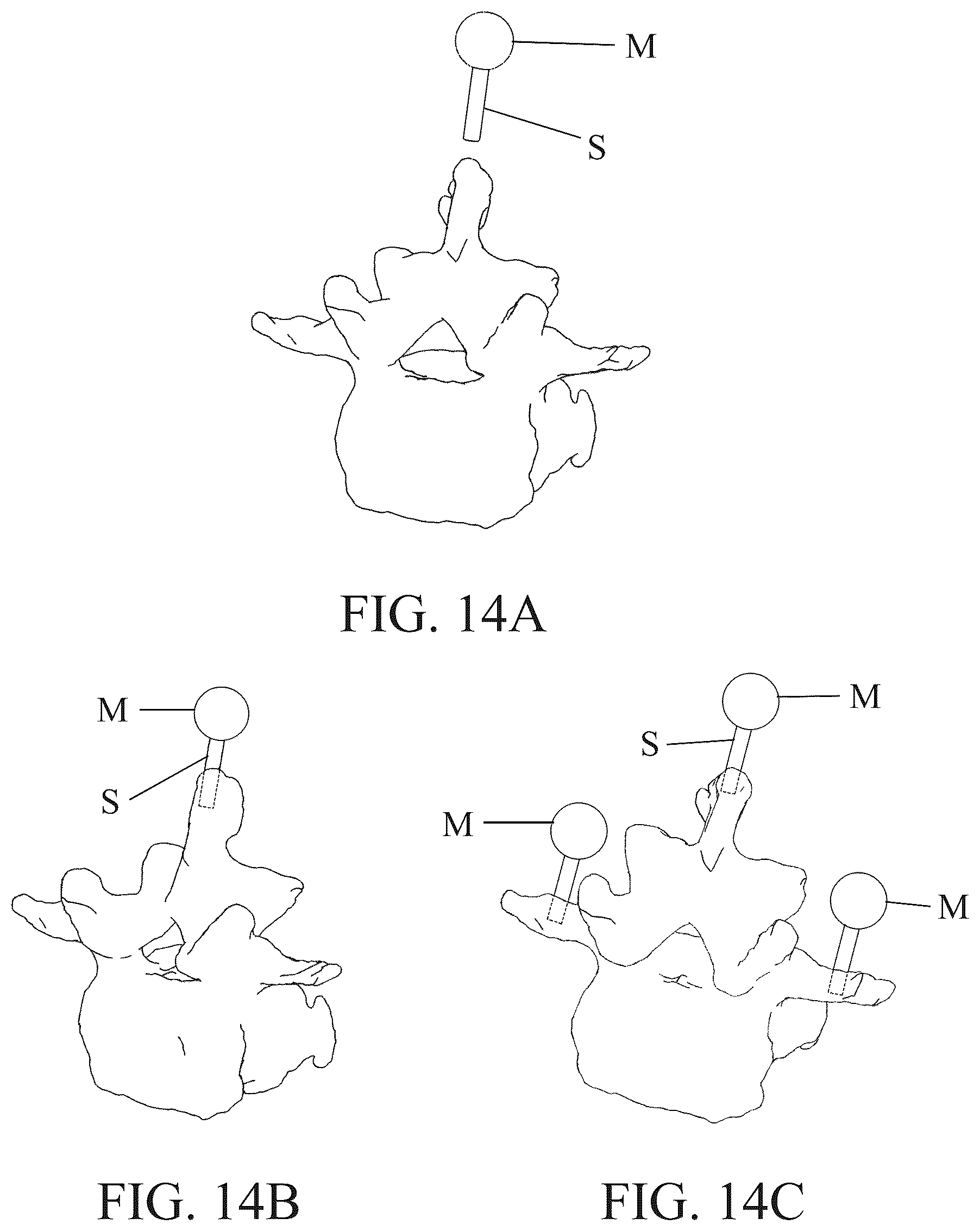 Patent US12350111 Figure 14 – Patient-matched apparatus for use in robotic assisted surgical procedures and methods for using the same