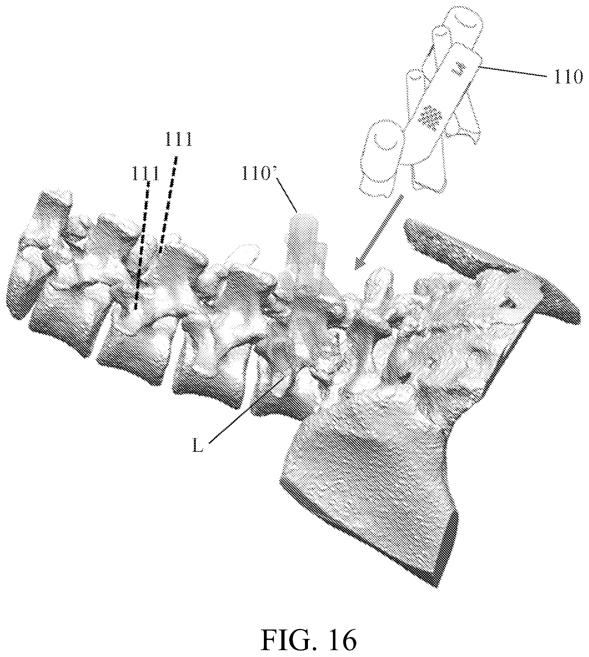 Patent US12350111 Figure 16 – Patient-matched apparatus for use in robotic assisted surgical procedures and methods for using the same