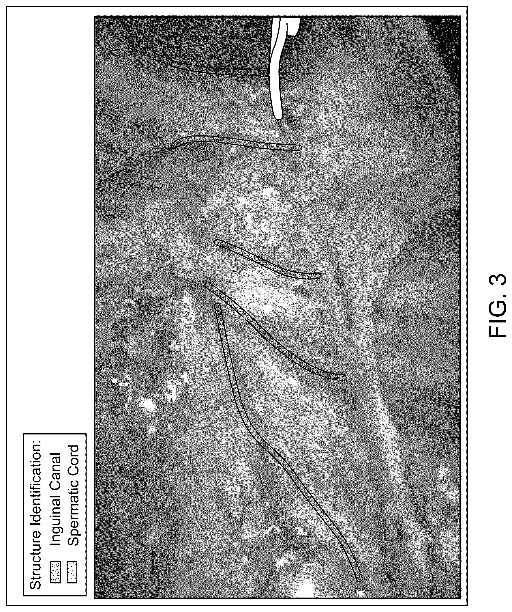 Patent US12350112 Figure 2 – Creating surgical annotations using anatomy identification