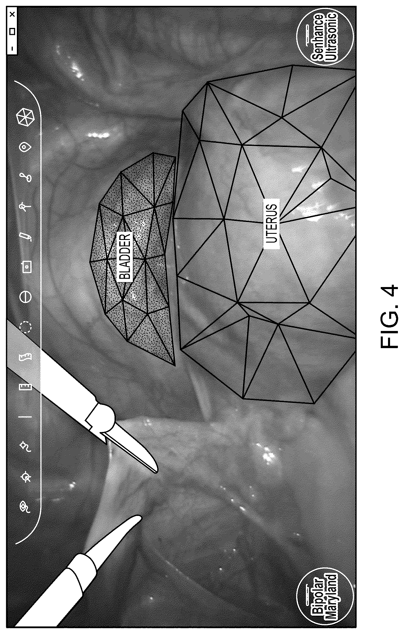 Patent US12350112 Figure 3 – Creating surgical annotations using anatomy identification