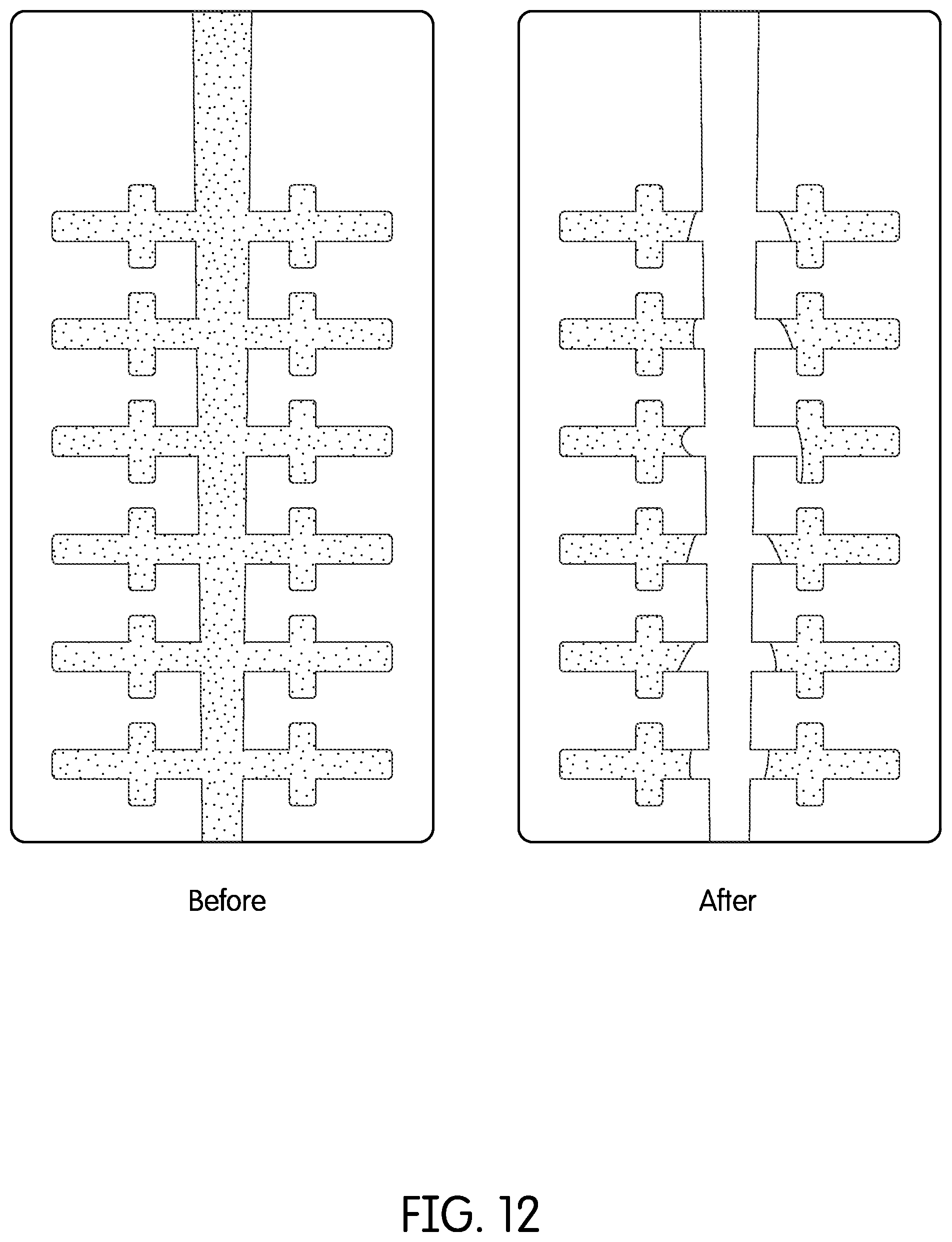 Patent US12350116 Figure 13 – Device for continuous irrigation with activation in endodontics application