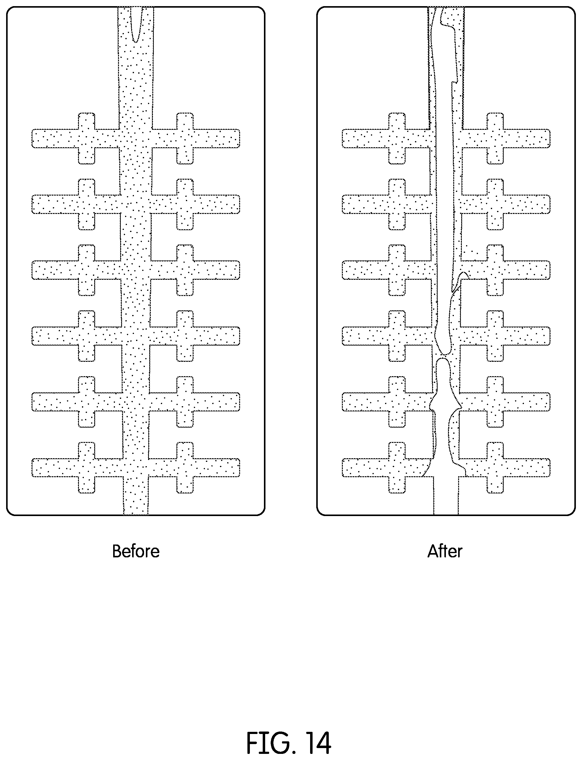 Patent US12350116 Figure 15 – Device for continuous irrigation with activation in endodontics application