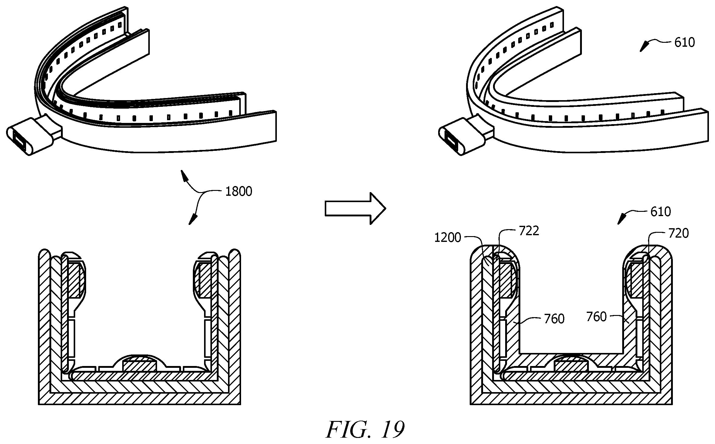 Patent US12350119 Figure 13 – Intra-oral appliance for delivering red, near-infrared and blue light for oral tissue healing