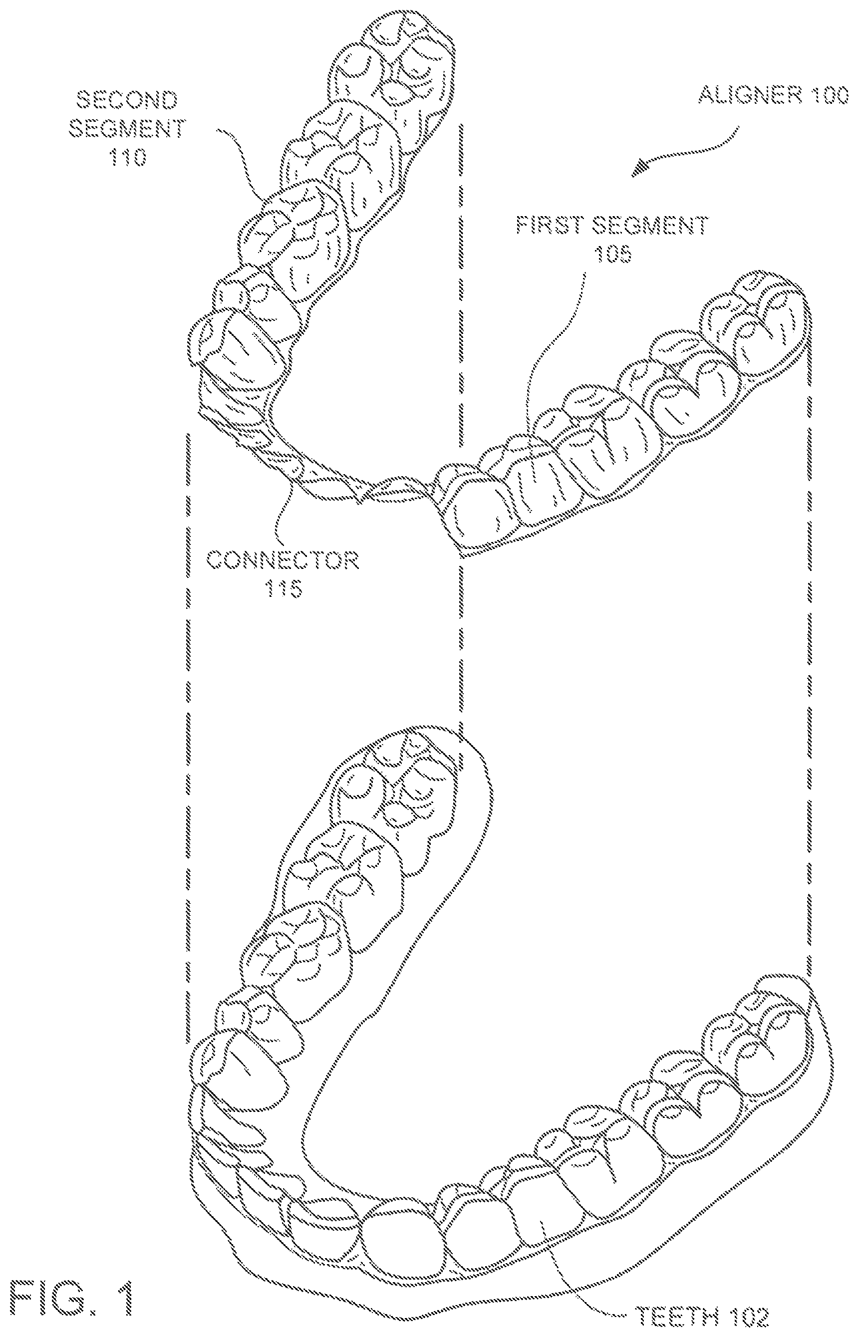 Patent US12350121 Figure 1 – Orthodontic aligner with isolated segments