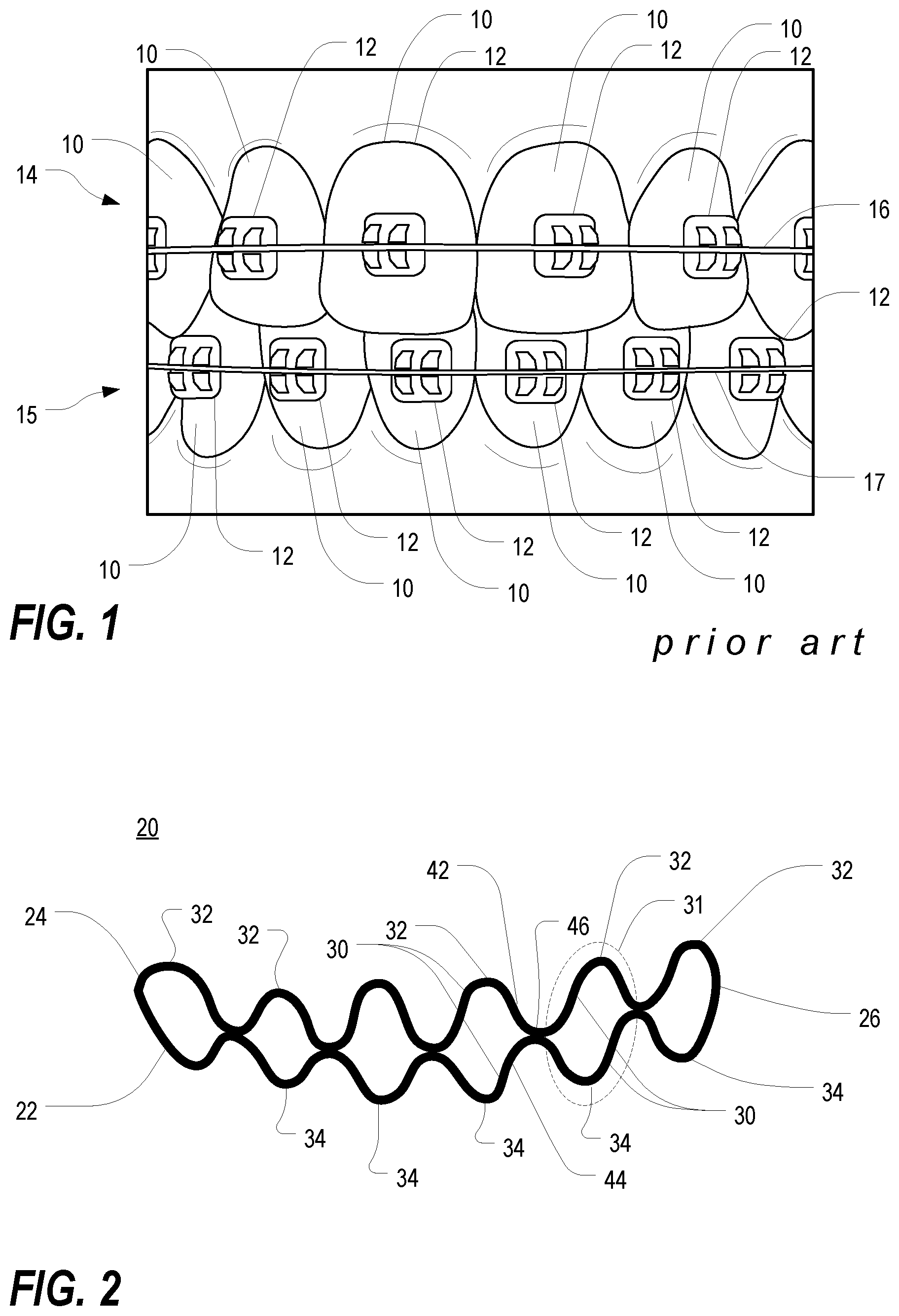 Patent US12350122 Figure 1 – Orthodontic device for lateral tooth movement