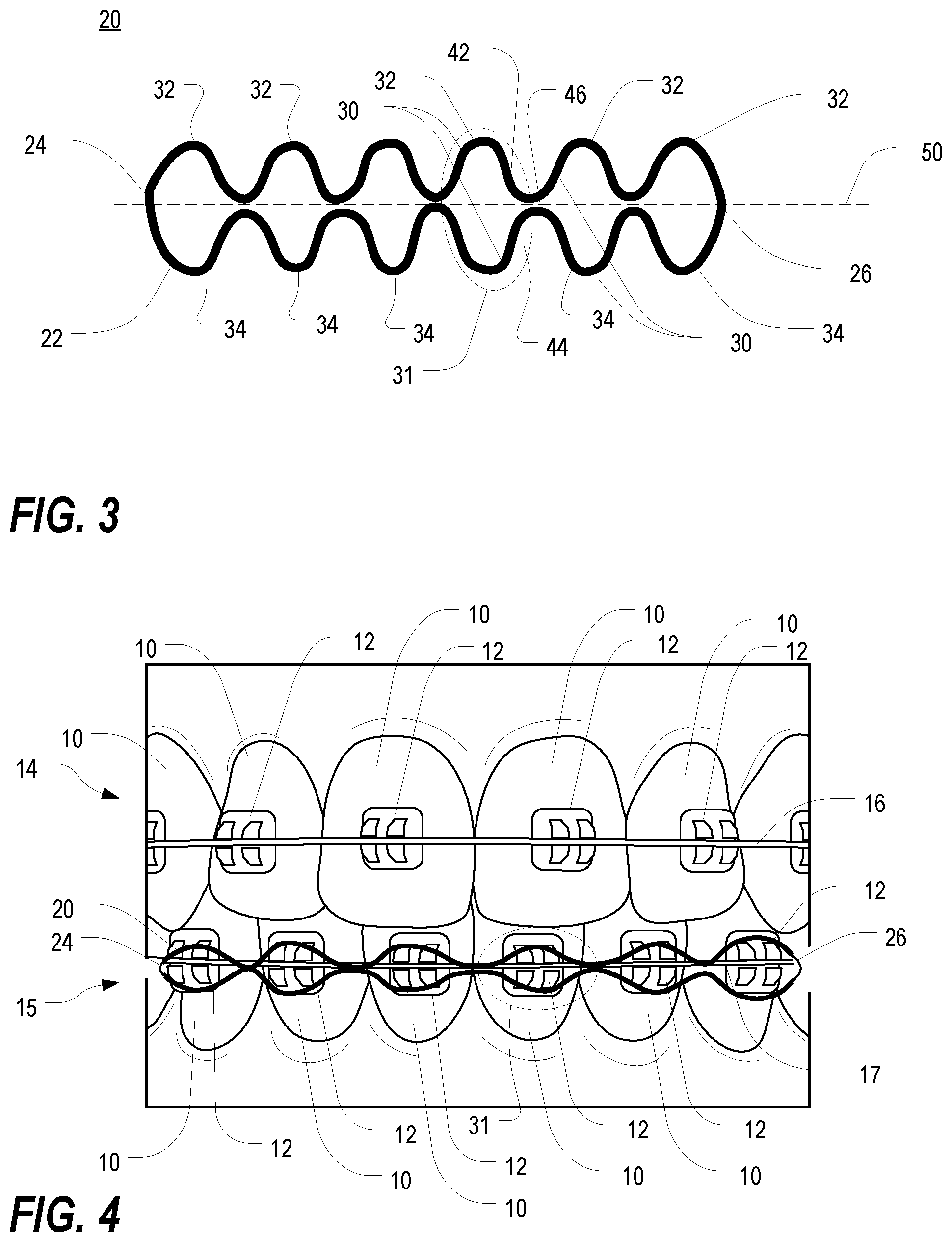 Patent US12350122 Figure 2 – Orthodontic device for lateral tooth movement