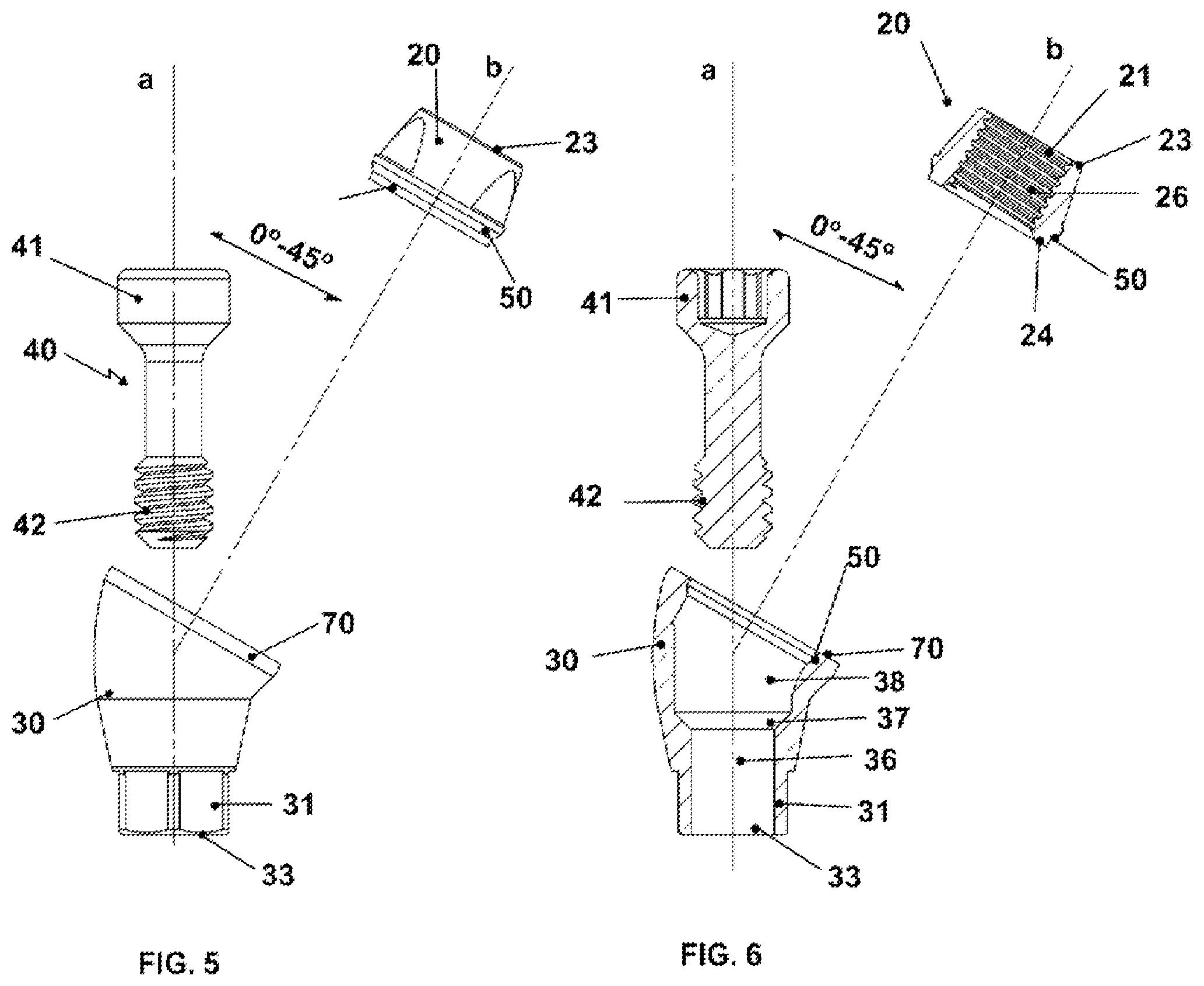 Patent US12350124 Figure 3 – Transepithelial abutment