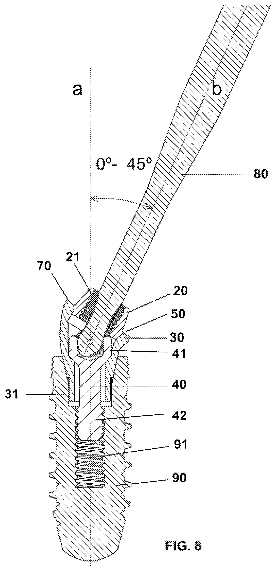 Patent US12350124 Figure 5 – Transepithelial abutment