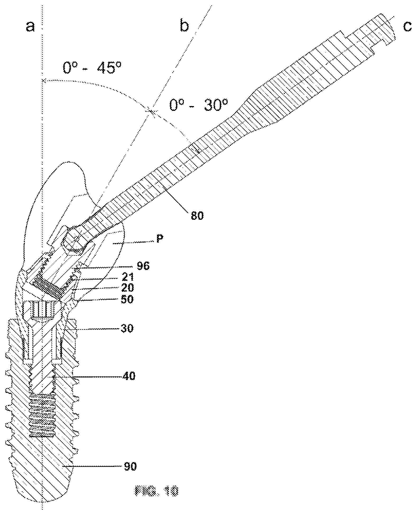 Patent US12350124 Figure 7 – Transepithelial abutment