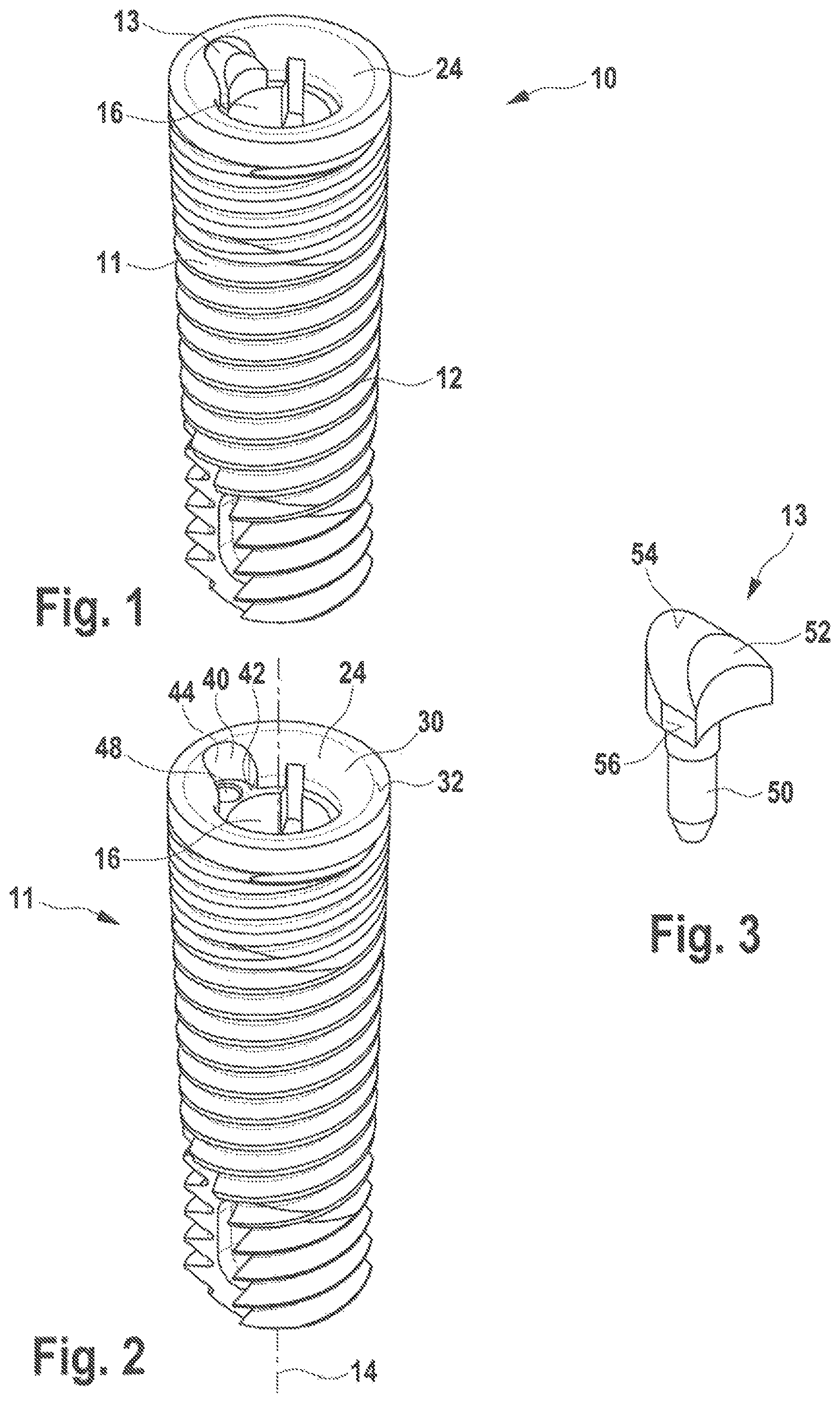 Patent US12350125 — Dental implant and dental prosthesis — Figure 1