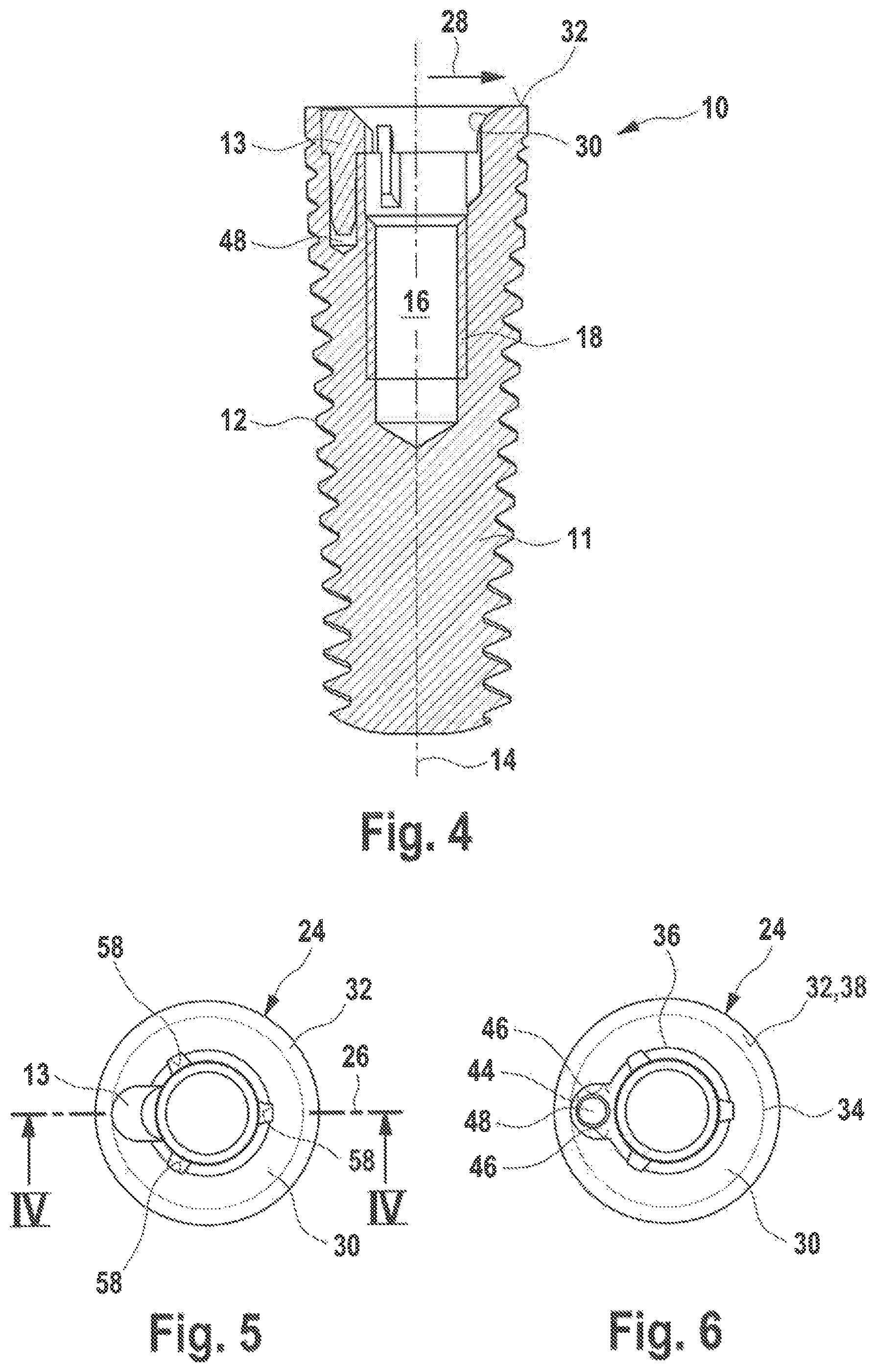 Patent US12350125 Figure 2 – Dental implant and dental prosthesis