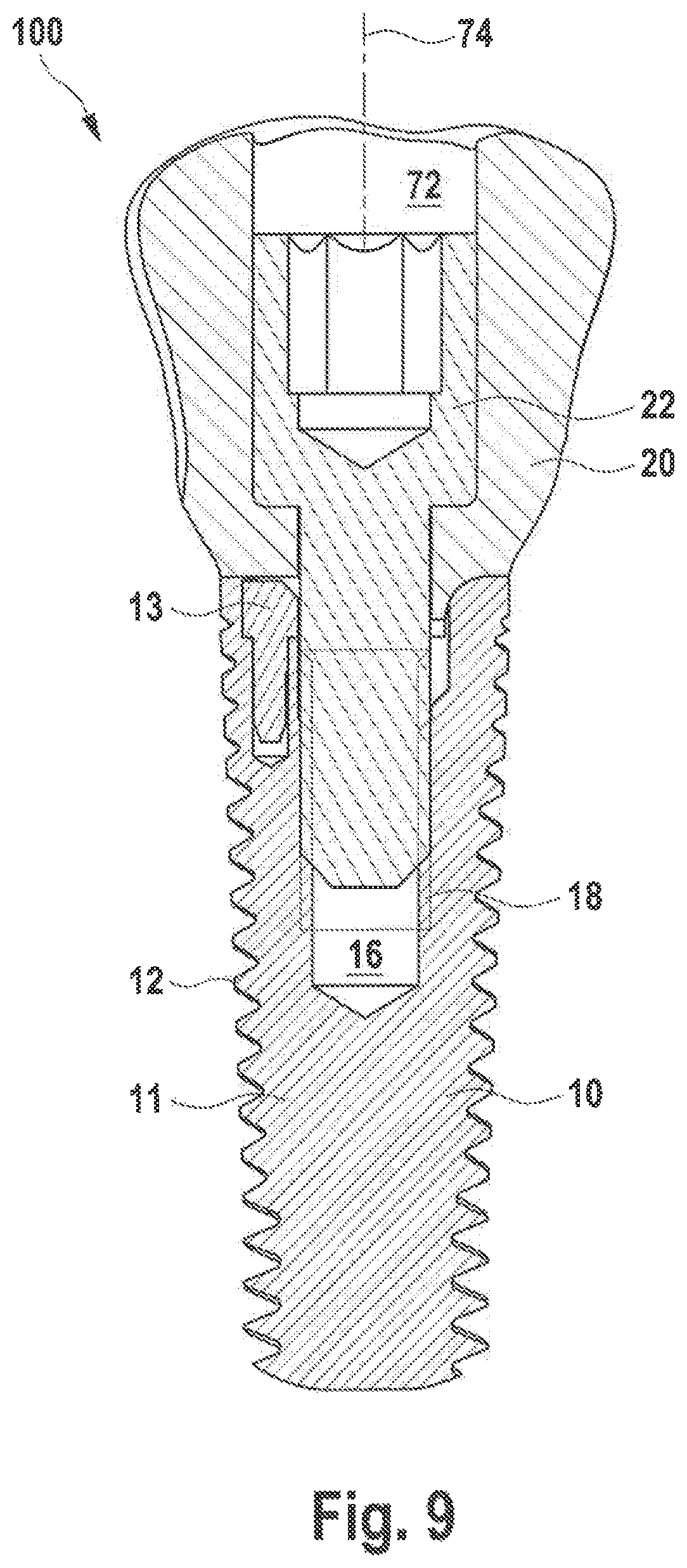 Patent US12350125 Figure 4 – Dental implant and dental prosthesis