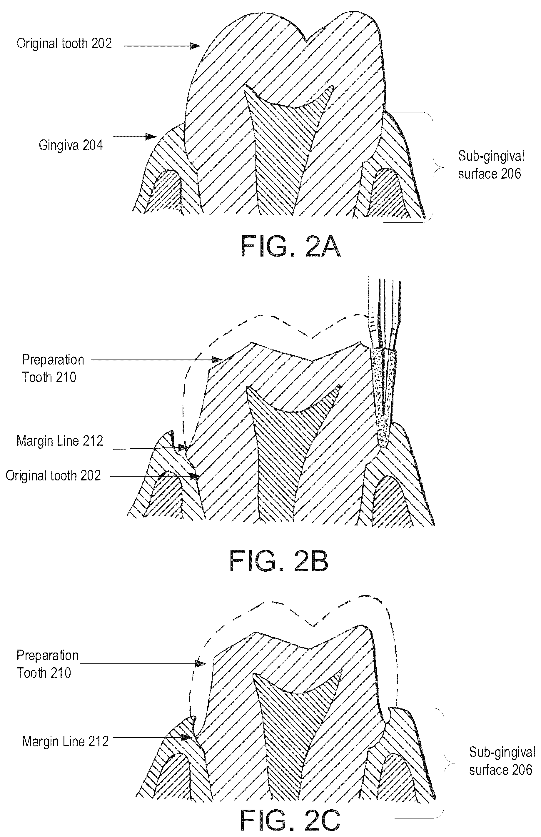 Patent US12350126 Figure 4 – Method generation of a sub-gingival surface of a tooth
