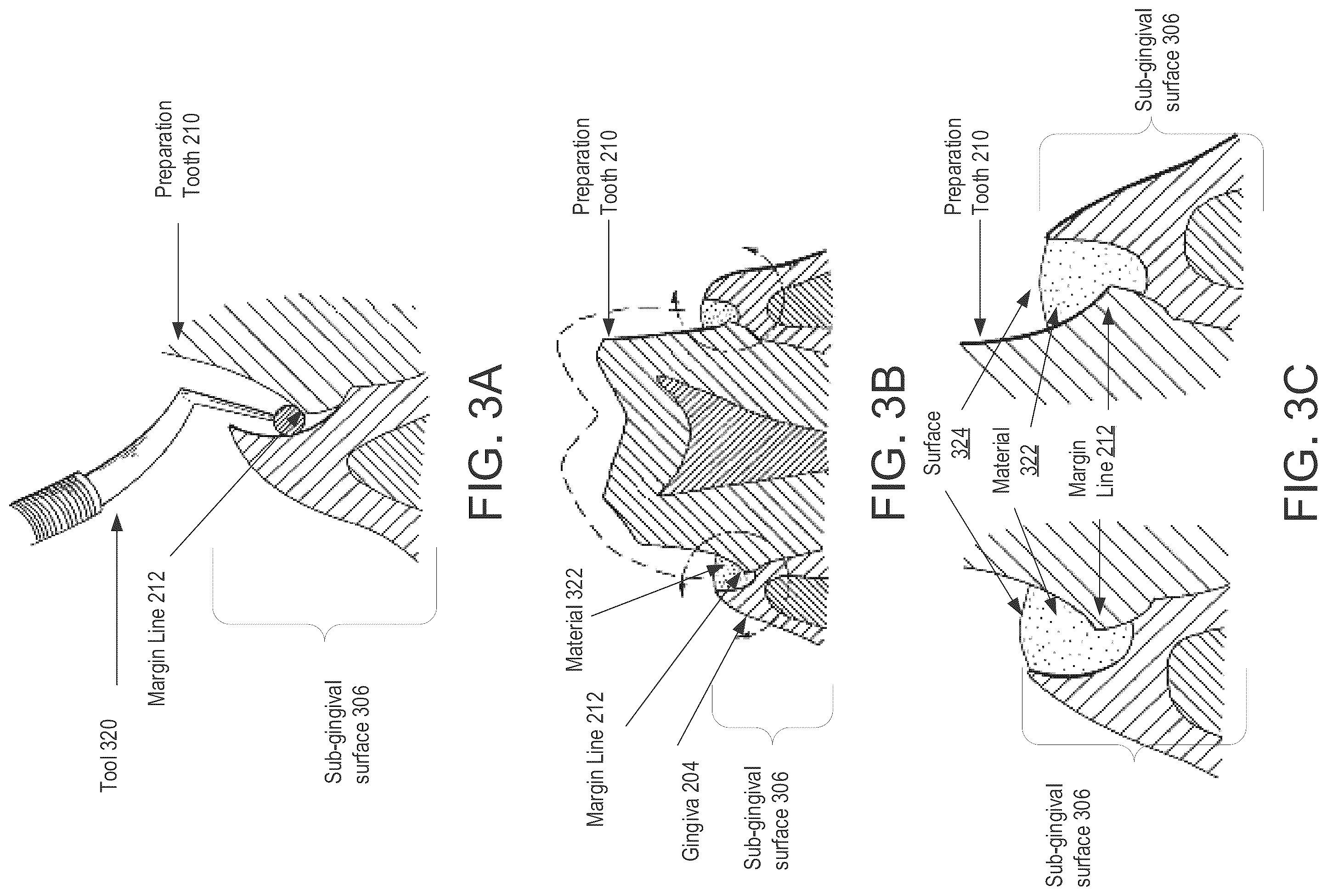 Patent US12350126 Figure 5 – Method generation of a sub-gingival surface of a tooth