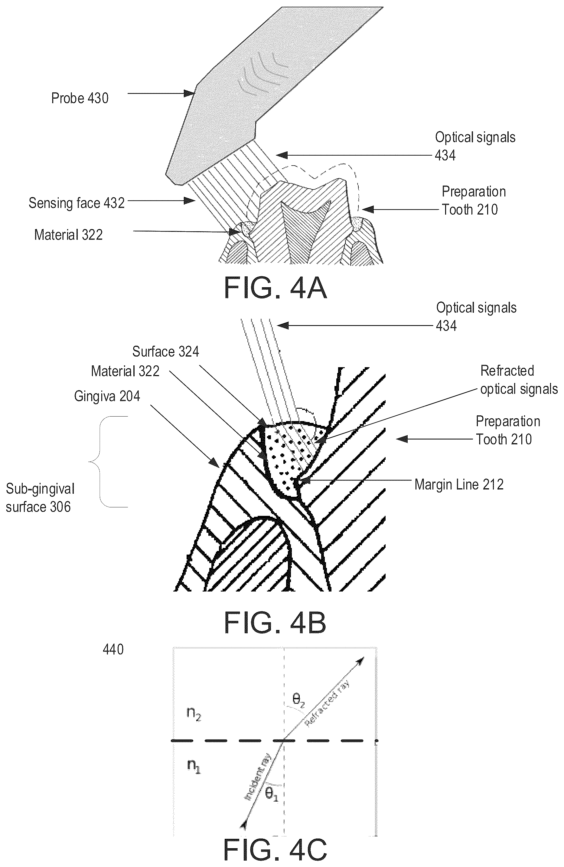Patent US12350126 Figure 6 – Method generation of a sub-gingival surface of a tooth